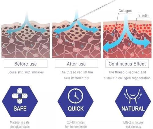 MatYas Pdo Cog 6D Threads 19G100MM, W-Type, 360R Bidirection Cog for Face Lift, 20pcs