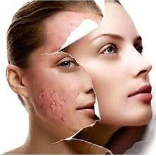 Acne-aid Acne-aid Liquid Cleanser for Pimples Oily Skin X 2 Boxes