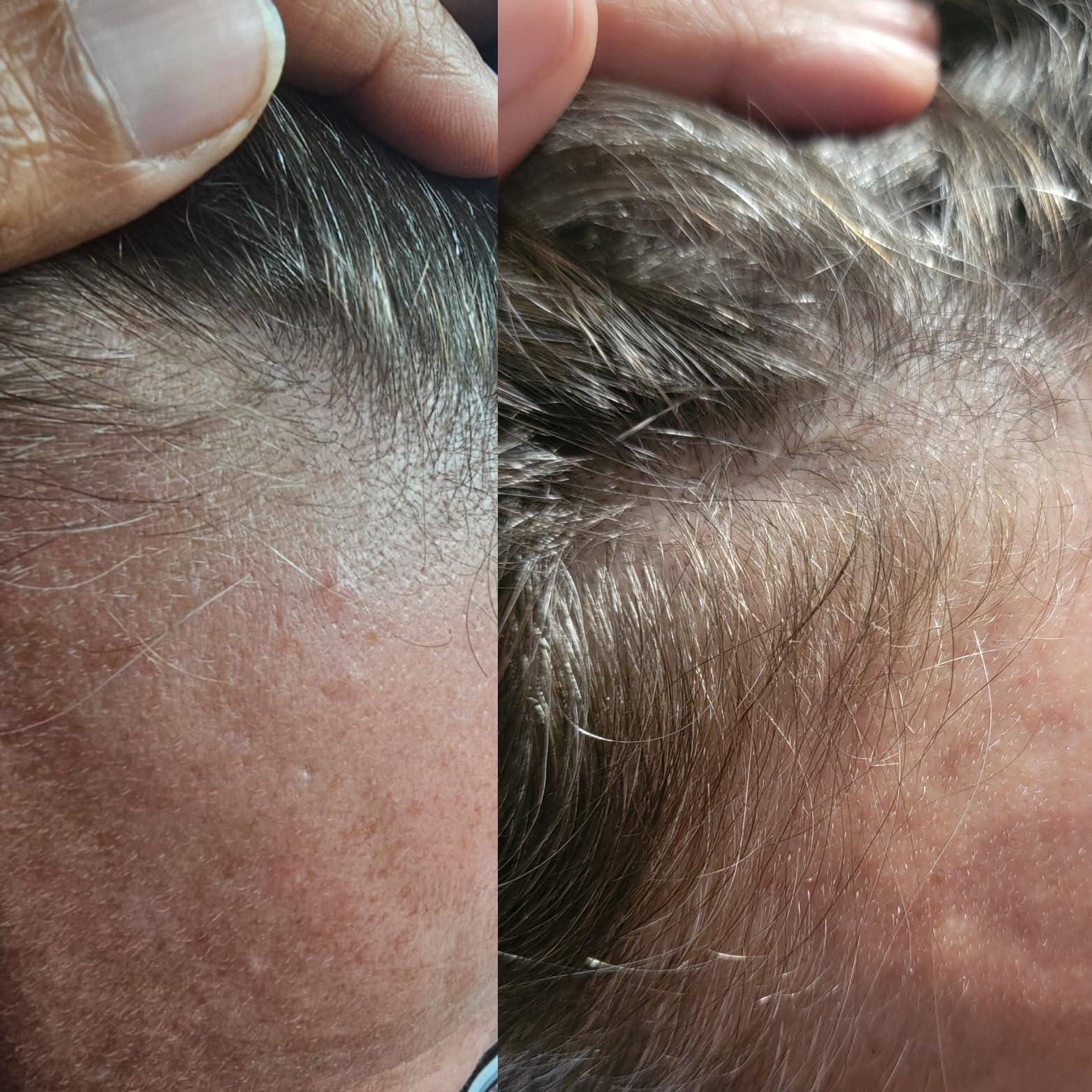 TRESSCURE TRESSCURE DHT Blocker Hair Growth Shampoo. Hair Regrowth Treatment for Men and Women.