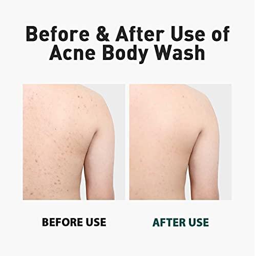 DASHU DASHU Daily Acne Relax Body Wash 16.9fl oz - Acne treatment, Cooling effect