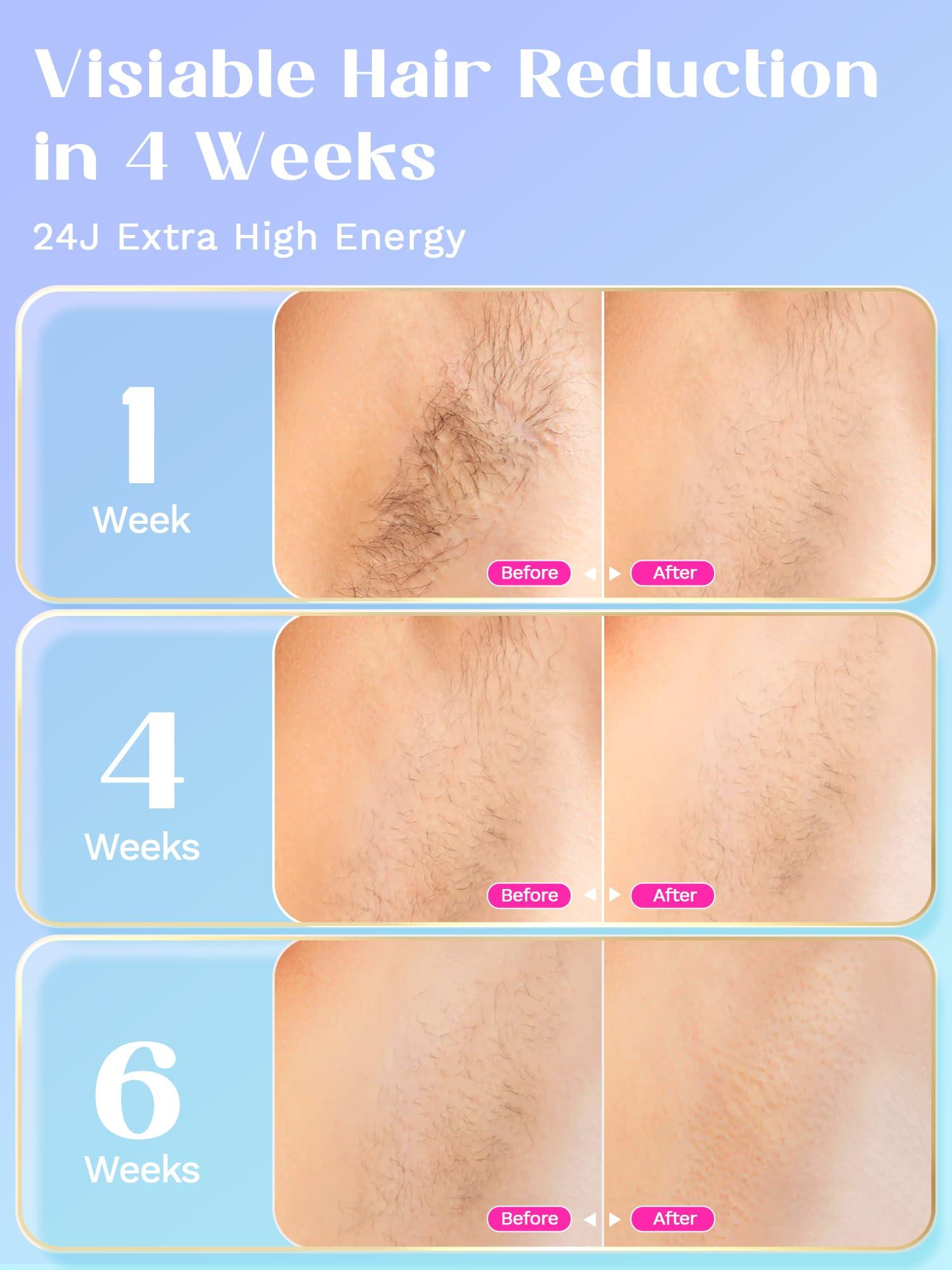 wavytalk Laser Hair Removal for Women and Men,IPL Hair Removal with Ice Cooling Function for Nearly Painless and Long-Lasting Results,24J High Energy IPL Laser Hair Removal for Armpits Legs Arms Bikini,Corded