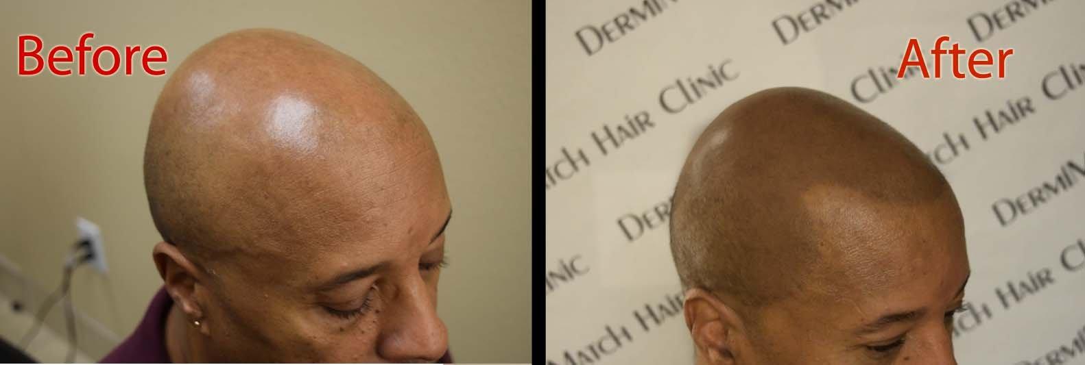 DermiMatch LLC B - Scalp micropigmentation pigments by DermMicro (B)