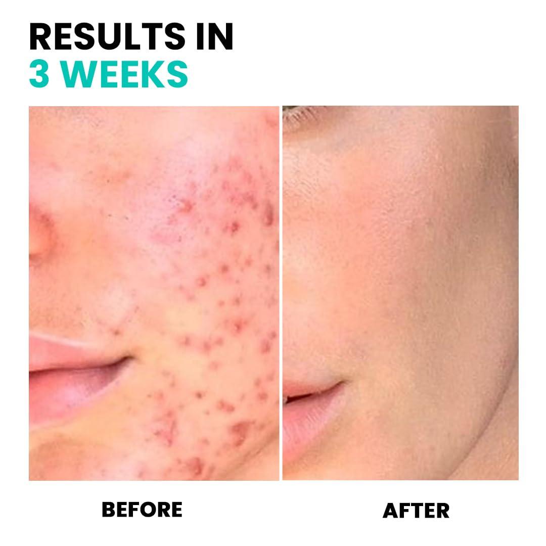 conatural Conatural Niacinamide Serum 30ml 10% + Zinc 1% - Anti-Aging Skin Serum & Pore Minimizer, Vitamin Serum for Skin, Glowing Complexion, Effective Solution for Open Pores & Large Pores Reduction