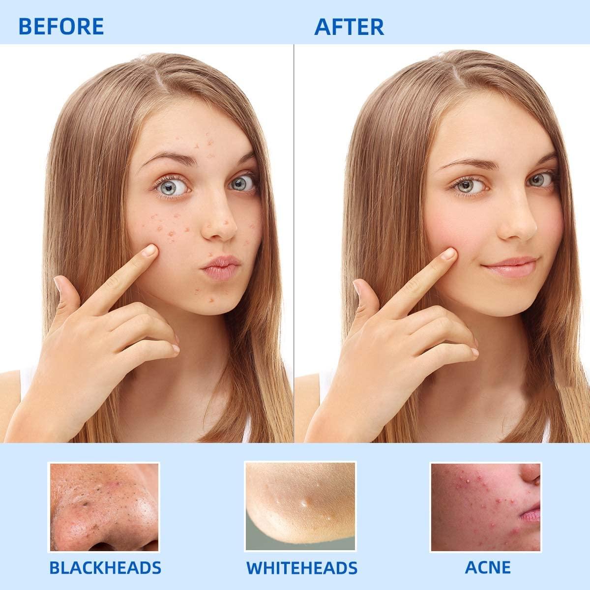 yuntop Blackhead Remover Tool Pimple Popper Tool Kit 5 Pack Blackhead Extractor Tools with Case Comedone Zit Acne Blemish Whitehead Removal Kit Professional Stainless Steel Extractor Tools for Face Nose