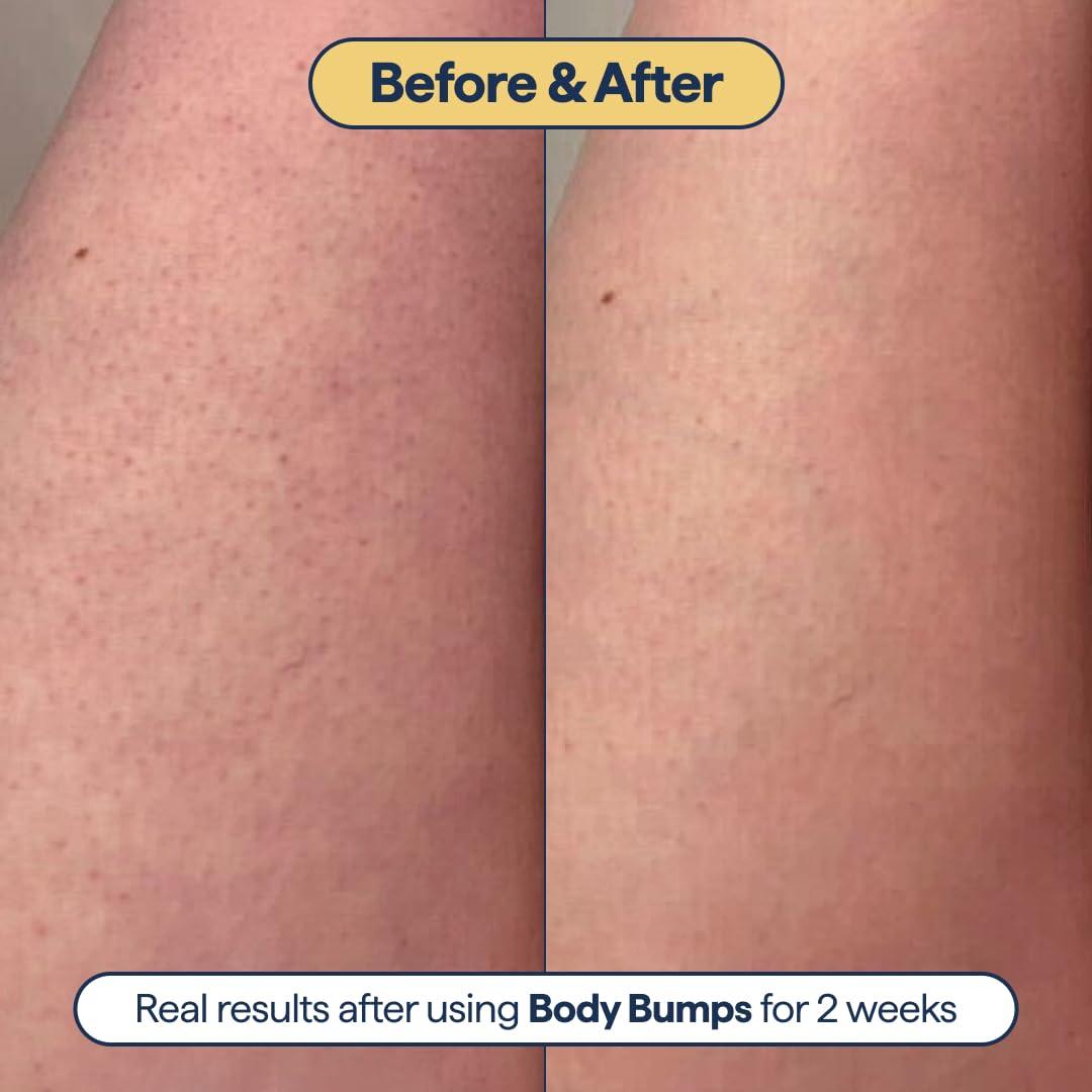 Remedy Science Remedy for Body Bumps Treatment for Keratosis Pilaris (KP) and Textured, Crepey Skin with Urea, Lactic Acid, and Retinol - Smoothing Body Moisturizer Lotion By Dermatologist Dr. Shah