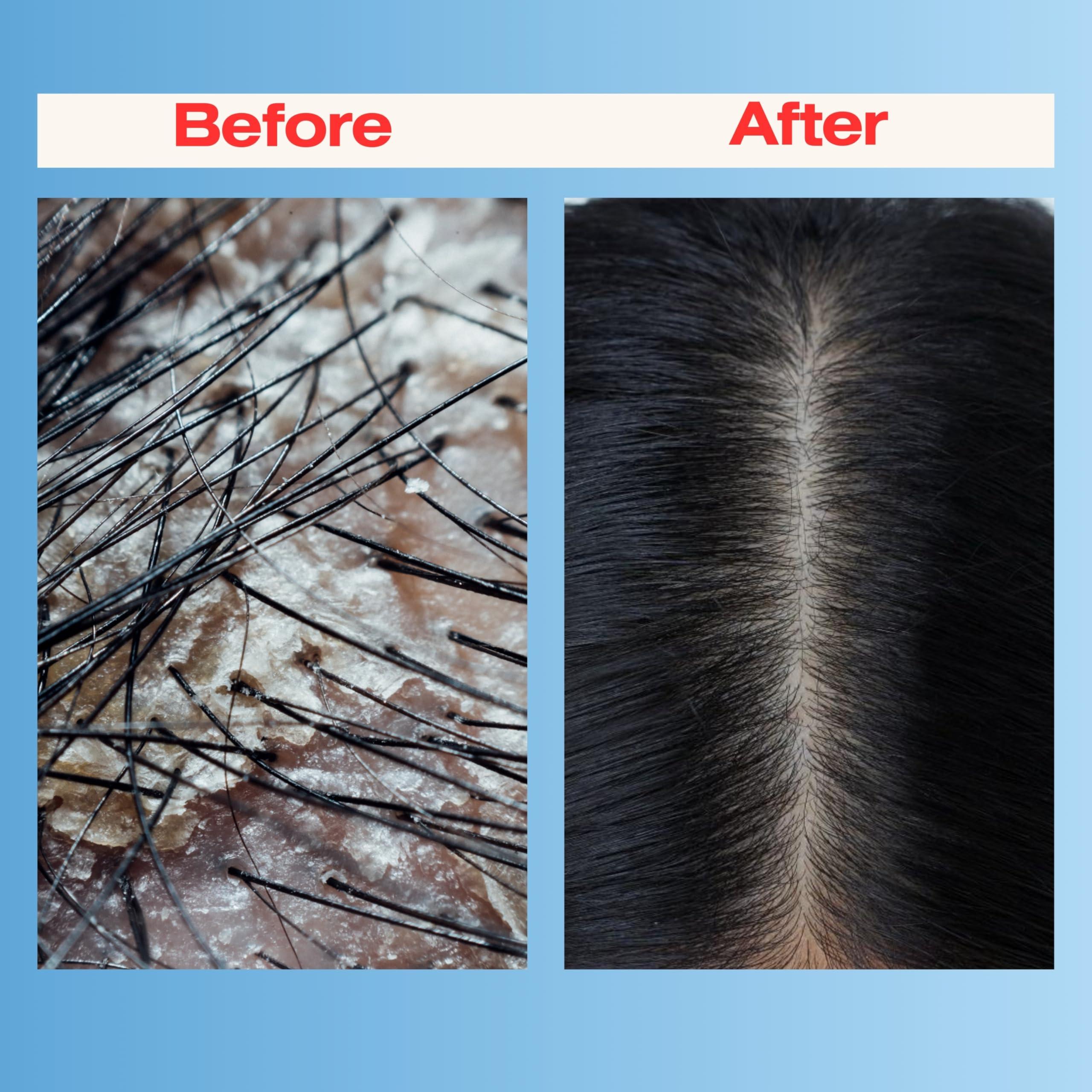 Therapro MEDIceuticals Therapro Mediceuticals Scalp Treatment - 3 Piece Kit (for Dandruff & Psoriasis)