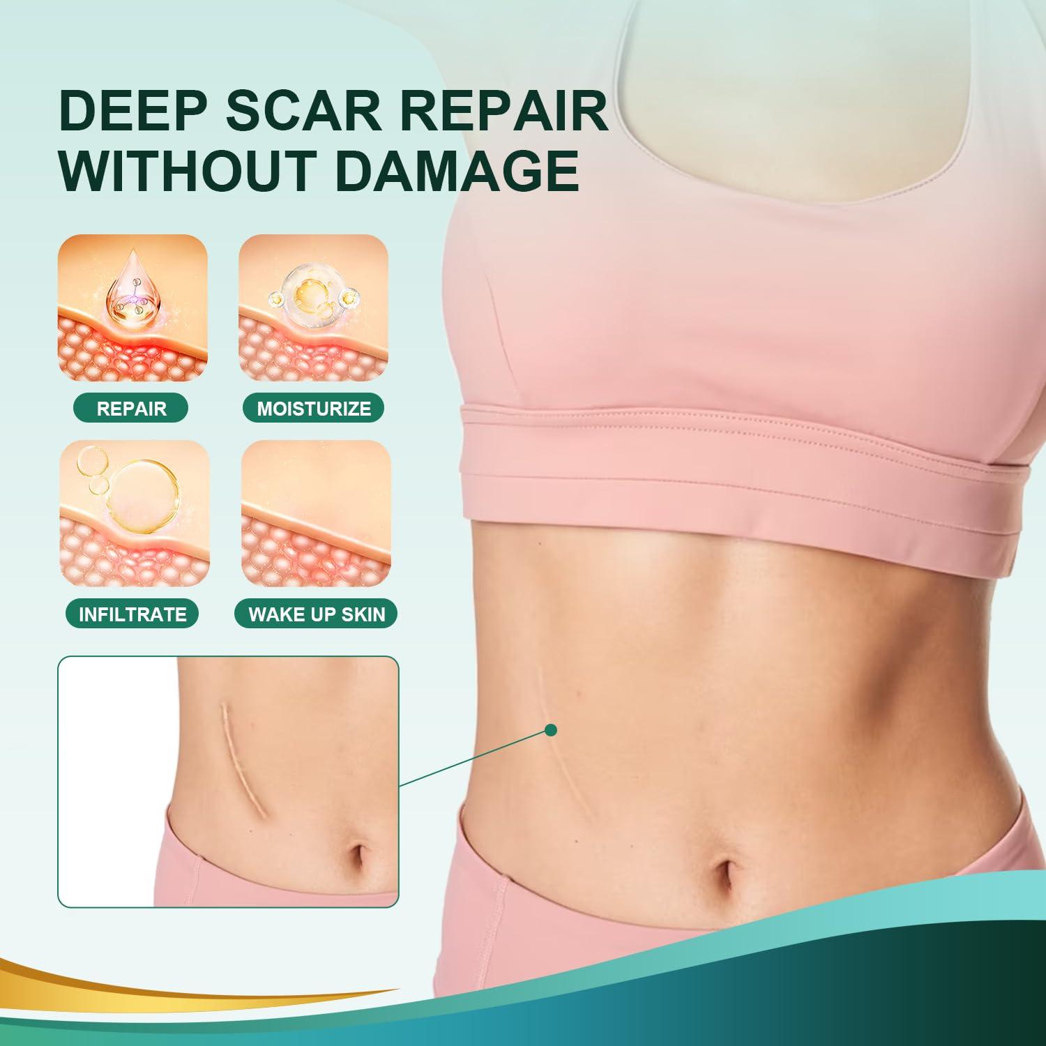 Gowgaw Medical Grade Silicone Scar Sheets, Silicone Scar Tape (1.6x 60 Roll-1.5M), Professional Scar Removal Treatment, Reusable Silicone Scar Strip for Keloid, C-Section, Surgery, Burns, Acne Etc