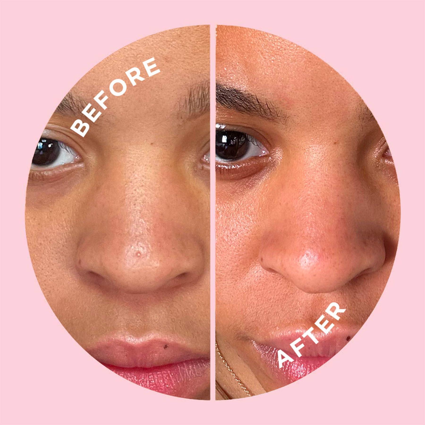 ZitSticka ZitSticka Hydrocolloid Surface Area Pimple Patches for Face - Clarifying Pore & Blemish for Large Zit T-Zone Coverage - Zit Sticker Absorbs Oil, Unclogs Pores, & Targets Clusters (NOSE PACK 8PC)