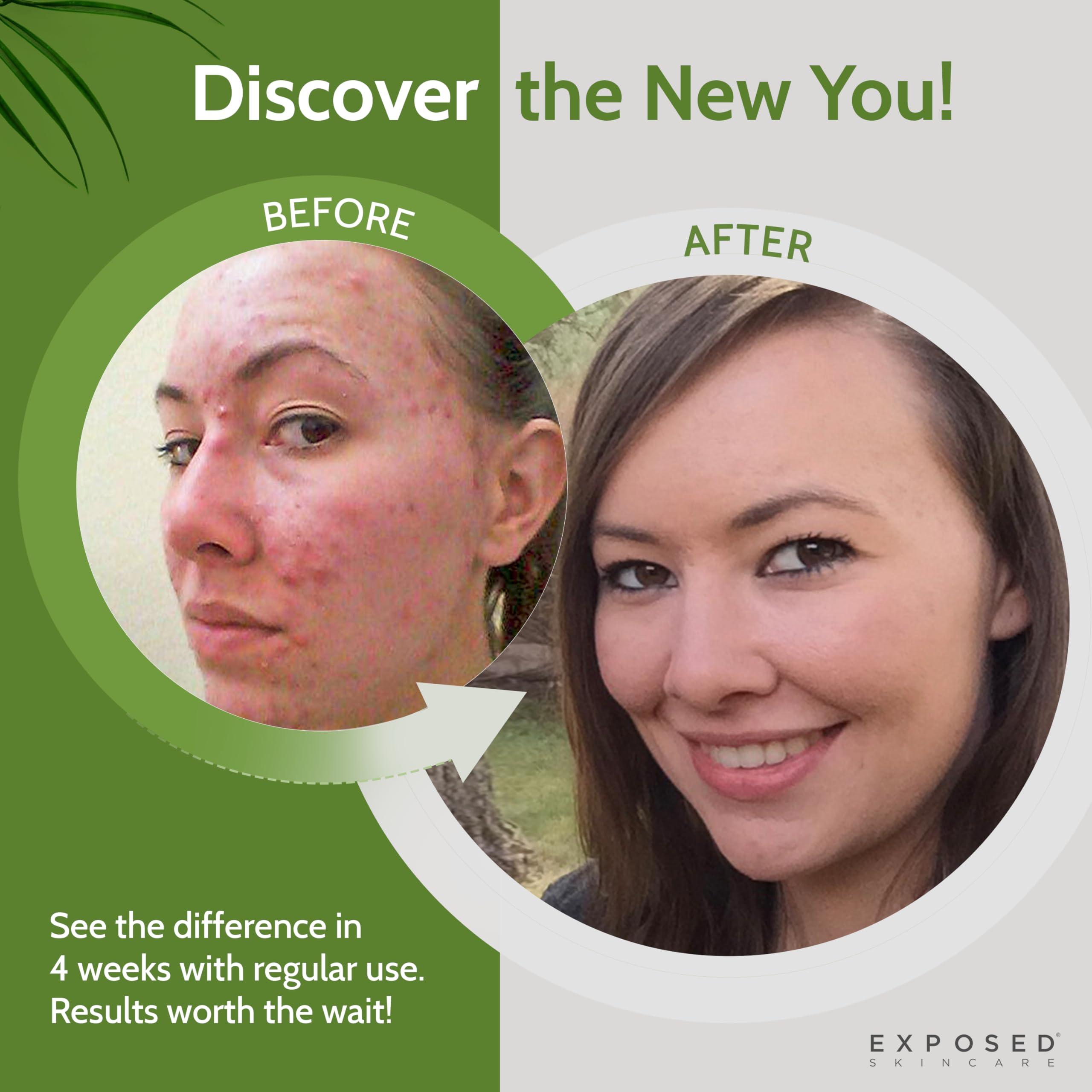 Exposed Skin Care Exposed Skin Care Expanded Acne Treatment Kit - Includes Salicylic Acid Face Wash, Clearing Tonic, Treatment Serum with Benzoyl Peroxide, Clear Pore Serum, Moisture Complex - Made for All Skin Types