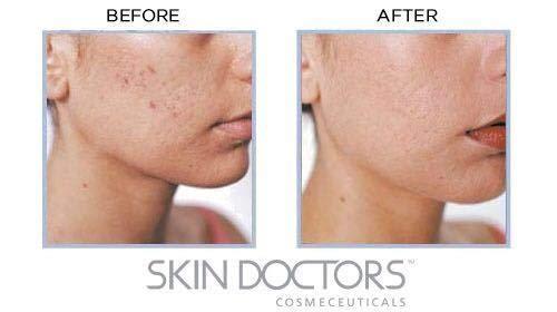 Skin Doctors #MC SKIN DOCTORS GAMMA HYDROXY CREAM 50ML -Gamma Hydroxy help to renew skin complexion in just 2 weeks reducing acne scarring, blackheads and whiteheads as well as skin pigmentation