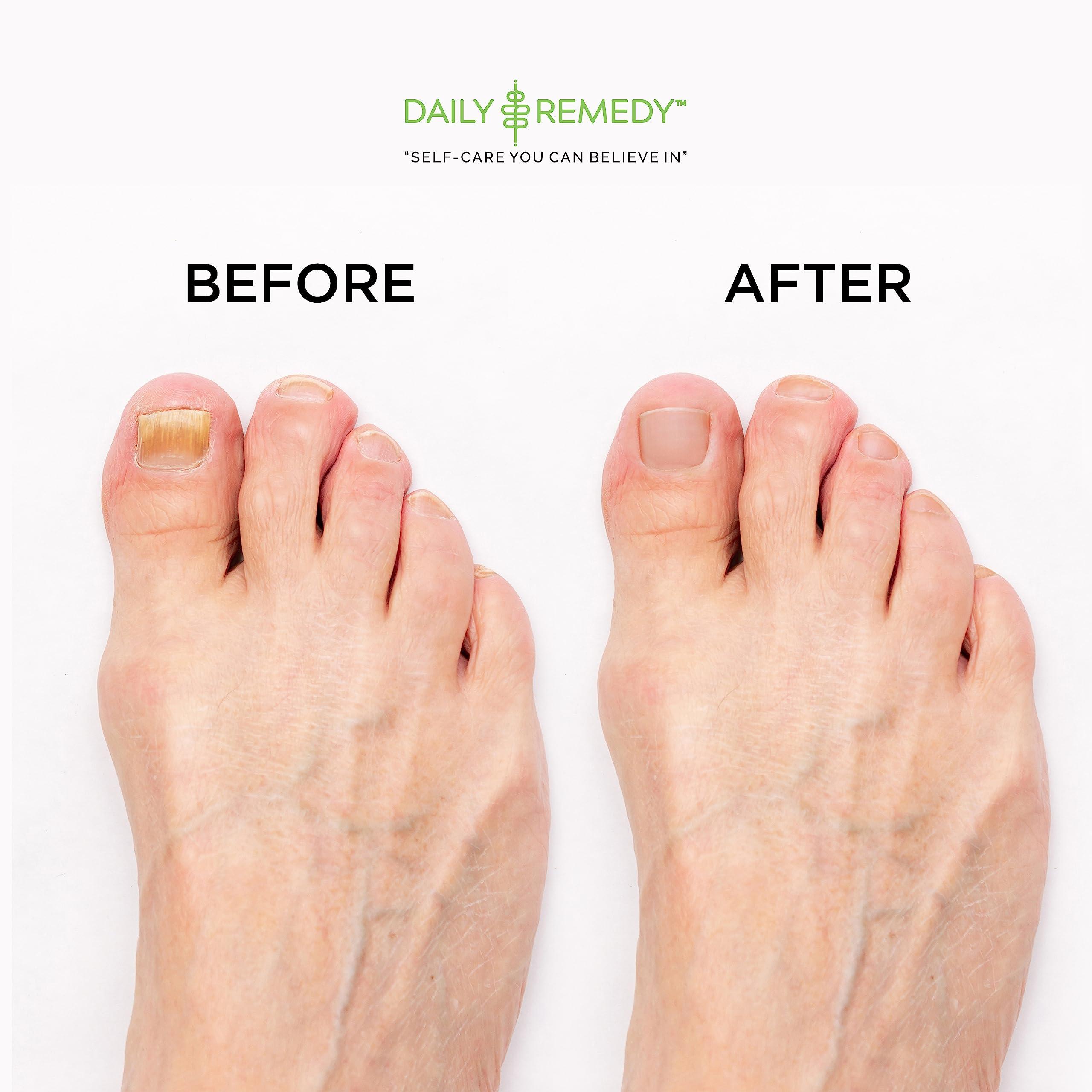 DAILY REMEDY EXTRA STRENGTH Tea Tree Oil Foot Soak with Epsom Salt - Made in USA - for Toenails, Athlete\'s Foot, Itchy Feet, Stubborn Smelly Foot Odor, Pedicure, Foot Calluses & Soothes Sore Tired Achy Feet -16 oz