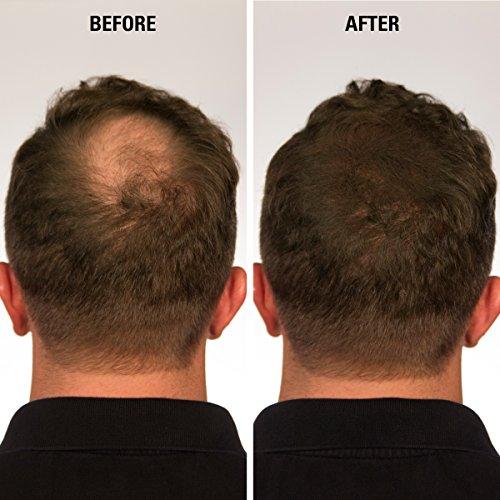 Eclipse Instant Hair Filler ECLIPSE Hair Fibers Dark Brown for Thinning Hair for Women & Men to Conceal Hair Loss in 15 Seconds - 100% Undetectable Hair Building Fibers, 15g