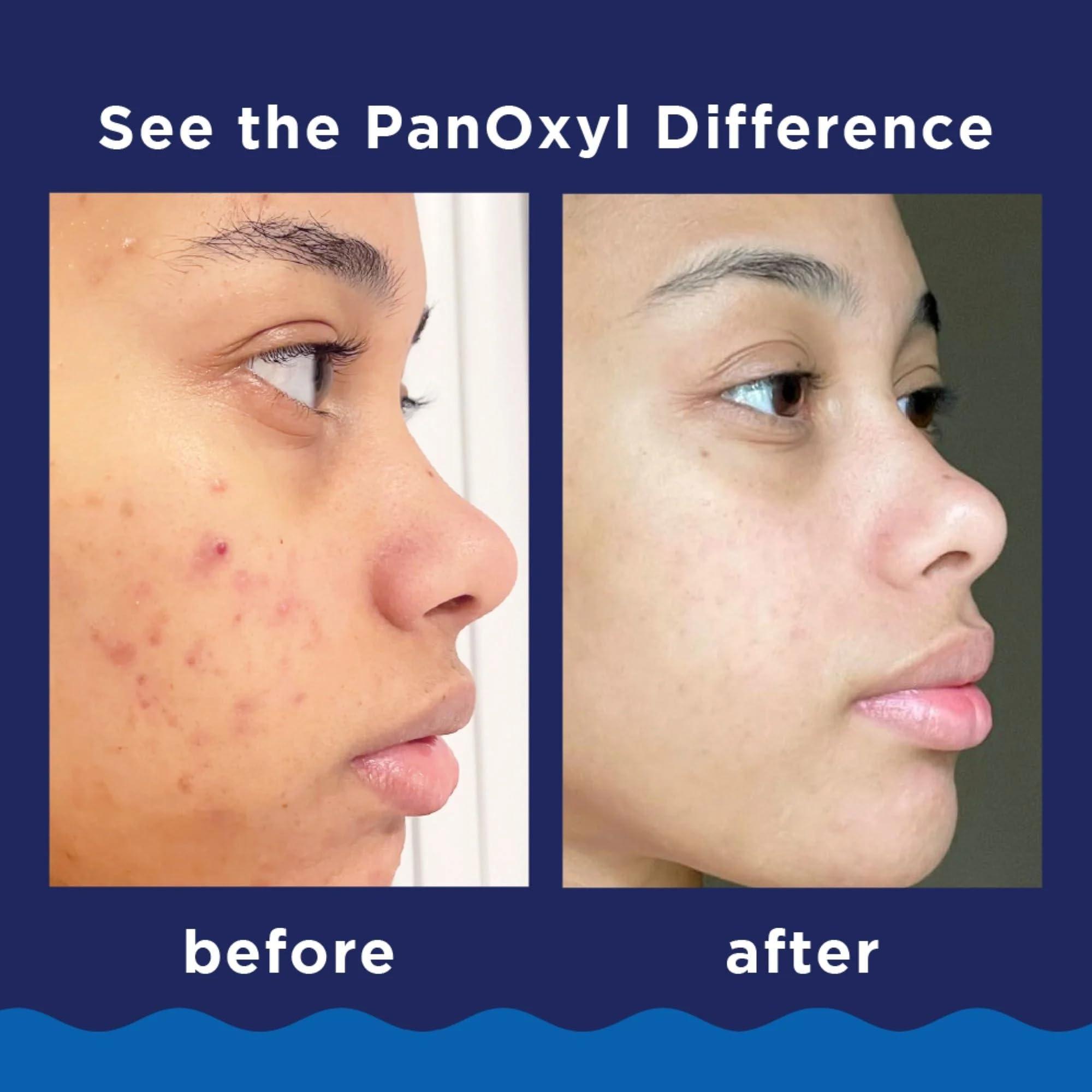 PanOxyl PanOxyl Acne Foaming Wash, 10% Benzoyl Peroxide 5.5 Ounce (Value Pack of 6)