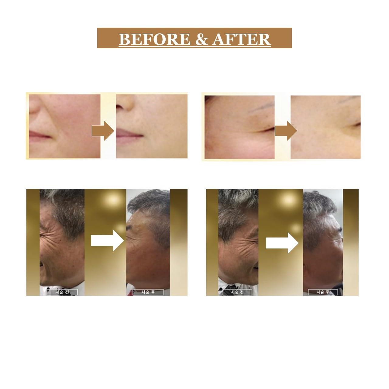 Generic HYUNSEOK 24K 99.99% Gold Threads for Face Lift/Smothing of Wrinkles/Long-Lasting Skin Rejuvenation and Firming for Body and Face Lifting 10PCS (KIM05 30G 13mm)