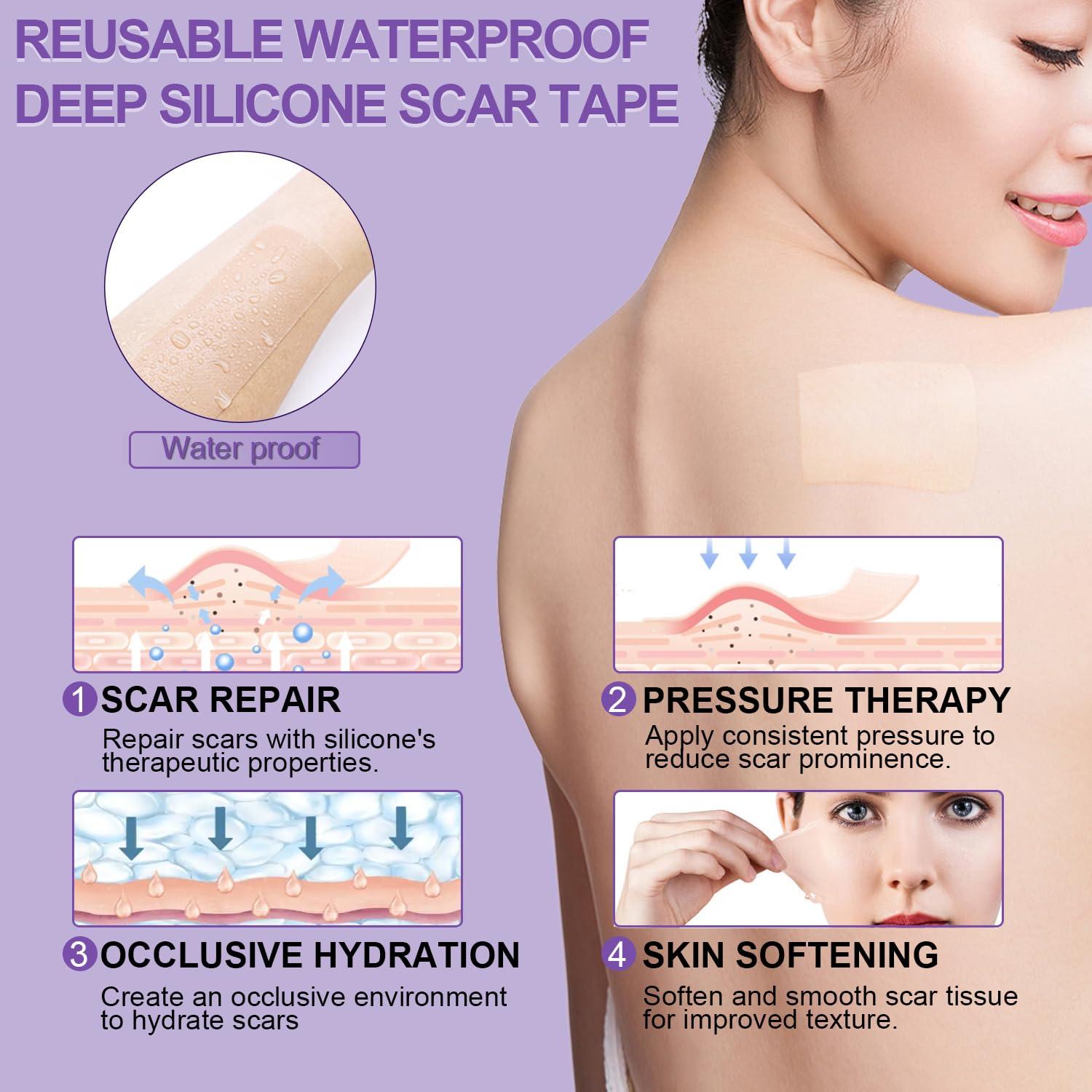 Mitgary Silicone Scar Sheets, Medical Grade Silicone Scar Tape (1.6\" x 120\"), Professional Scar Removal Treatment, Reusable, for Healing Keloids, Surgeries Scars, C-sections, and Burns