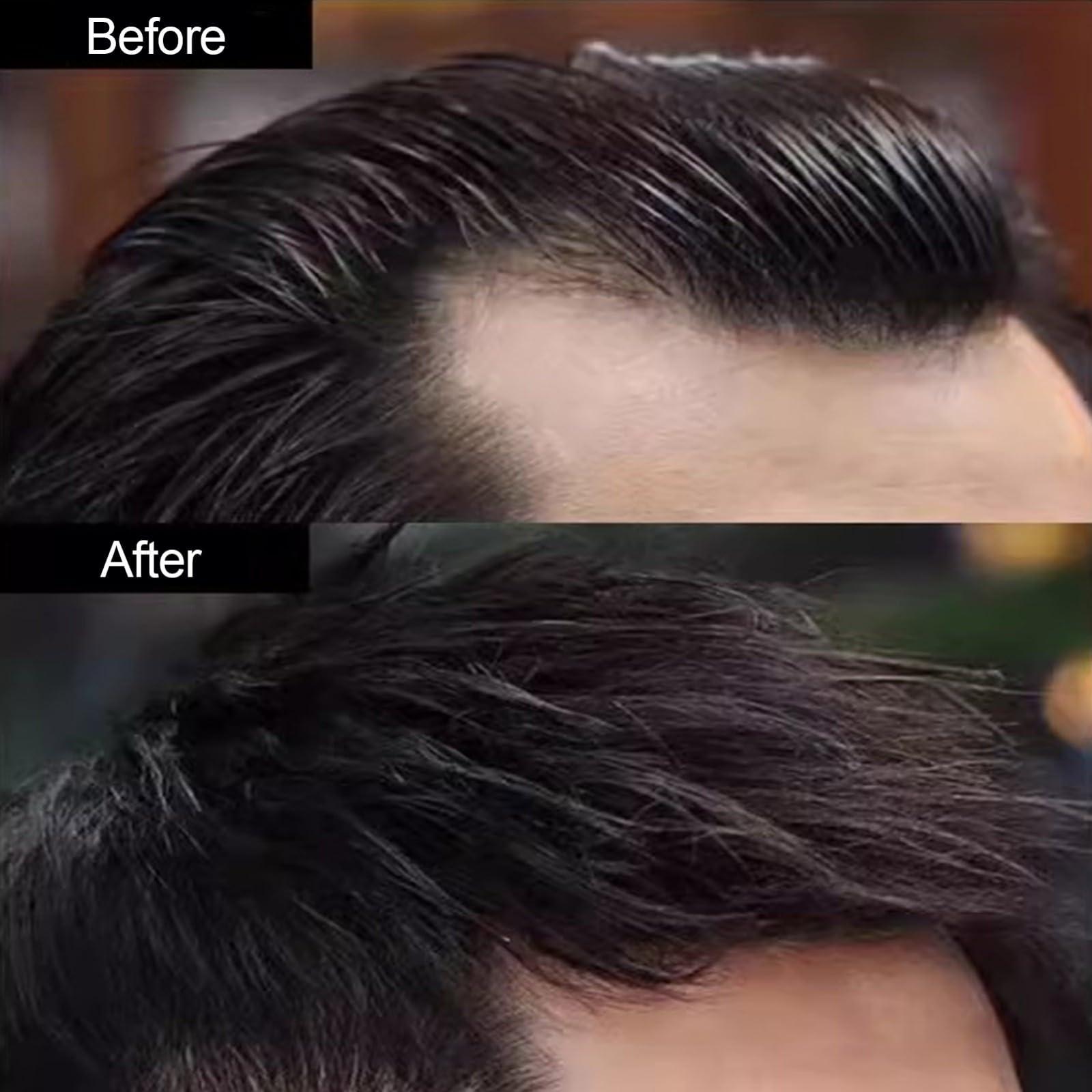 ZBYXPP ZBYXPP Front Hairline Hair Patch, Human Hair Replacement Burns Without Hair for Bald Spot Toupee Men/Women Hair Loss Cover-Up(6cm,3 * 3 * 4)