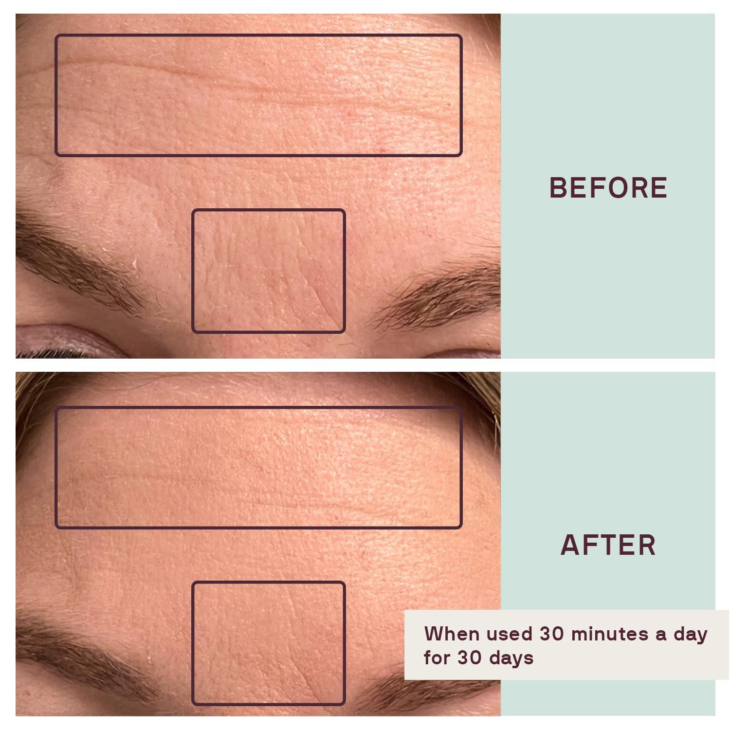 Dermaclara Dermaclara Face Patches Kit - Anti Wrinkle Patches for Forehead, Smile Lines, Silicone Anti-Wrinkle Frown Line Treatment, Up to 30 Uses - 1 Forehead, 2 Mouth, 2 Eye, 1 Neck & 1 Patch Prep Cleanser