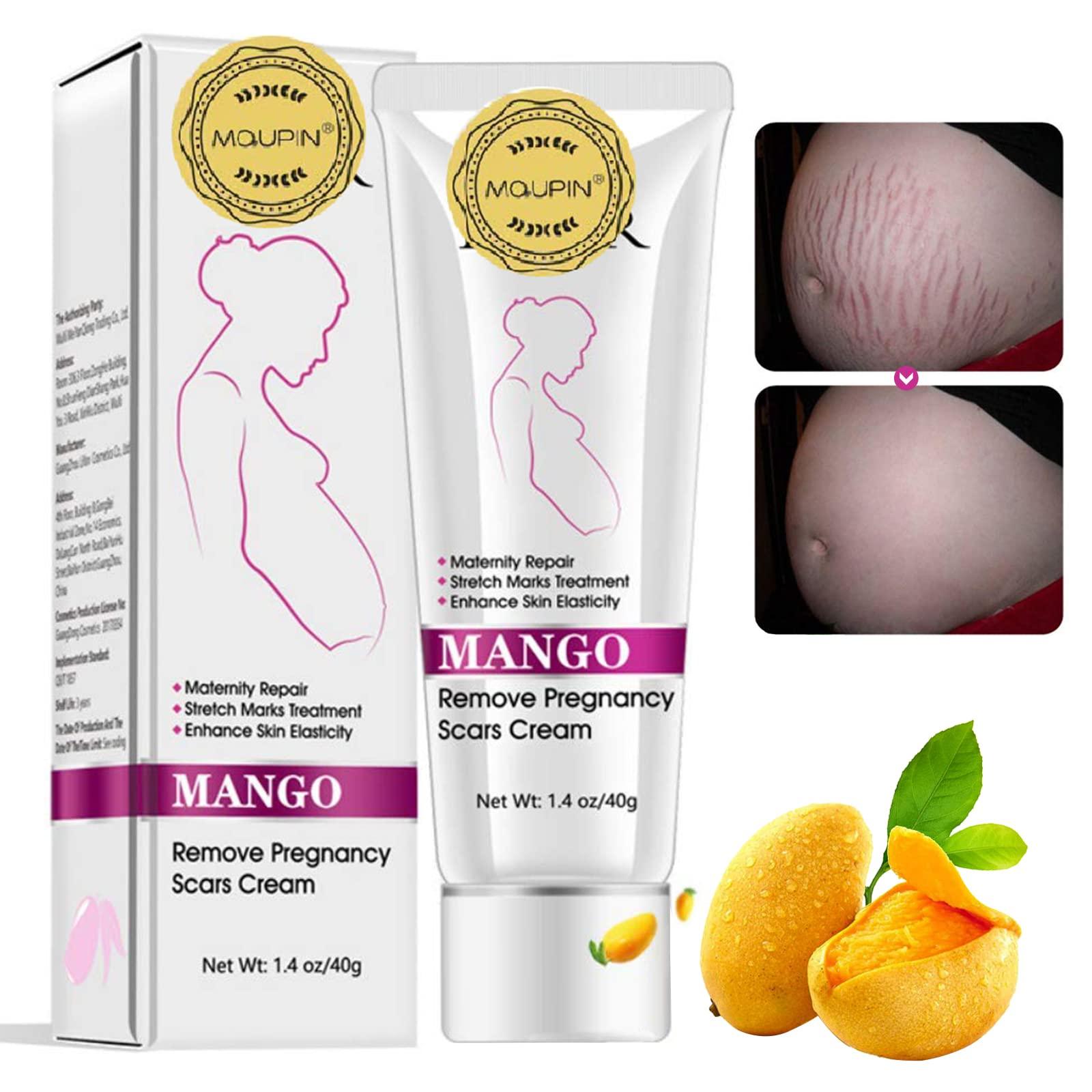 MQUPIN RtopR Mango Stretch Marks and Scar Cream -Stretch Marks and Scar Removal Cream for Pregnancy - Best Body Moisturizer-40g