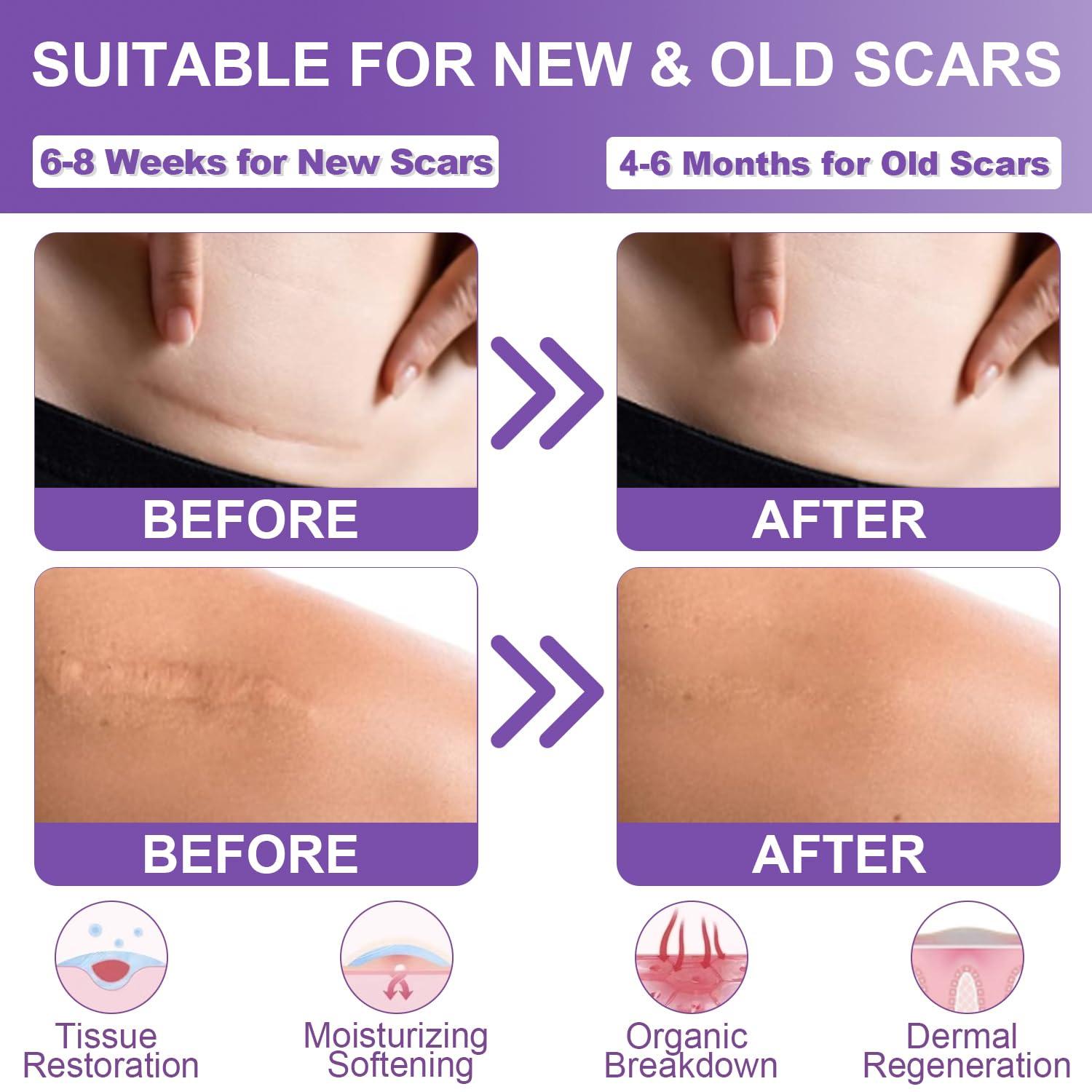 Mitgary Silicone Scar Sheets, Medical Grade Silicone Scar Tape (1.6\" x 120\"), Professional Scar Removal Treatment, Reusable, for Healing Keloids, Surgeries Scars, C-sections, and Burns