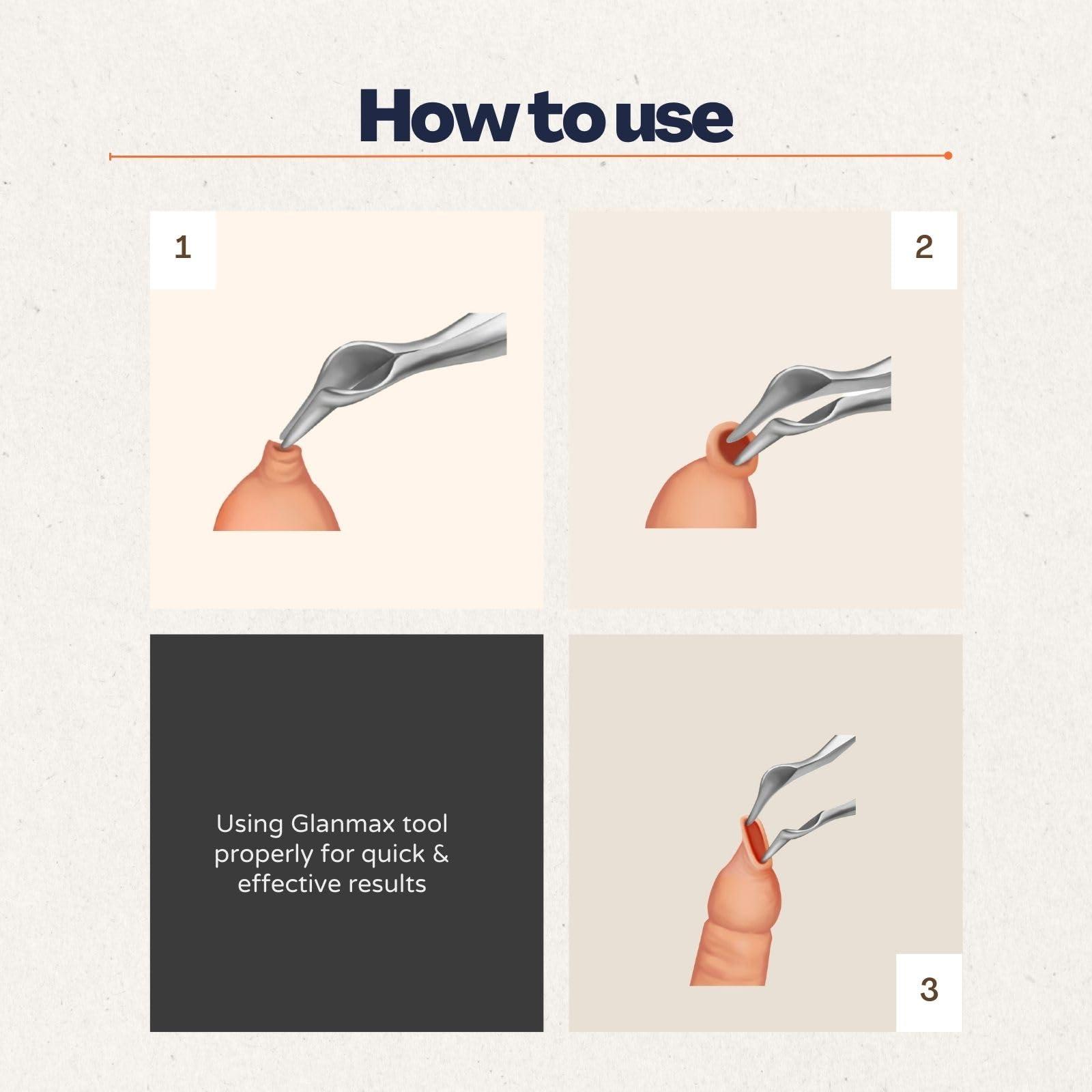 Cause Human GlanMax tool for phimosis | Phimosis Stretching tool | Opens upto 24mm | Safe & very quick results