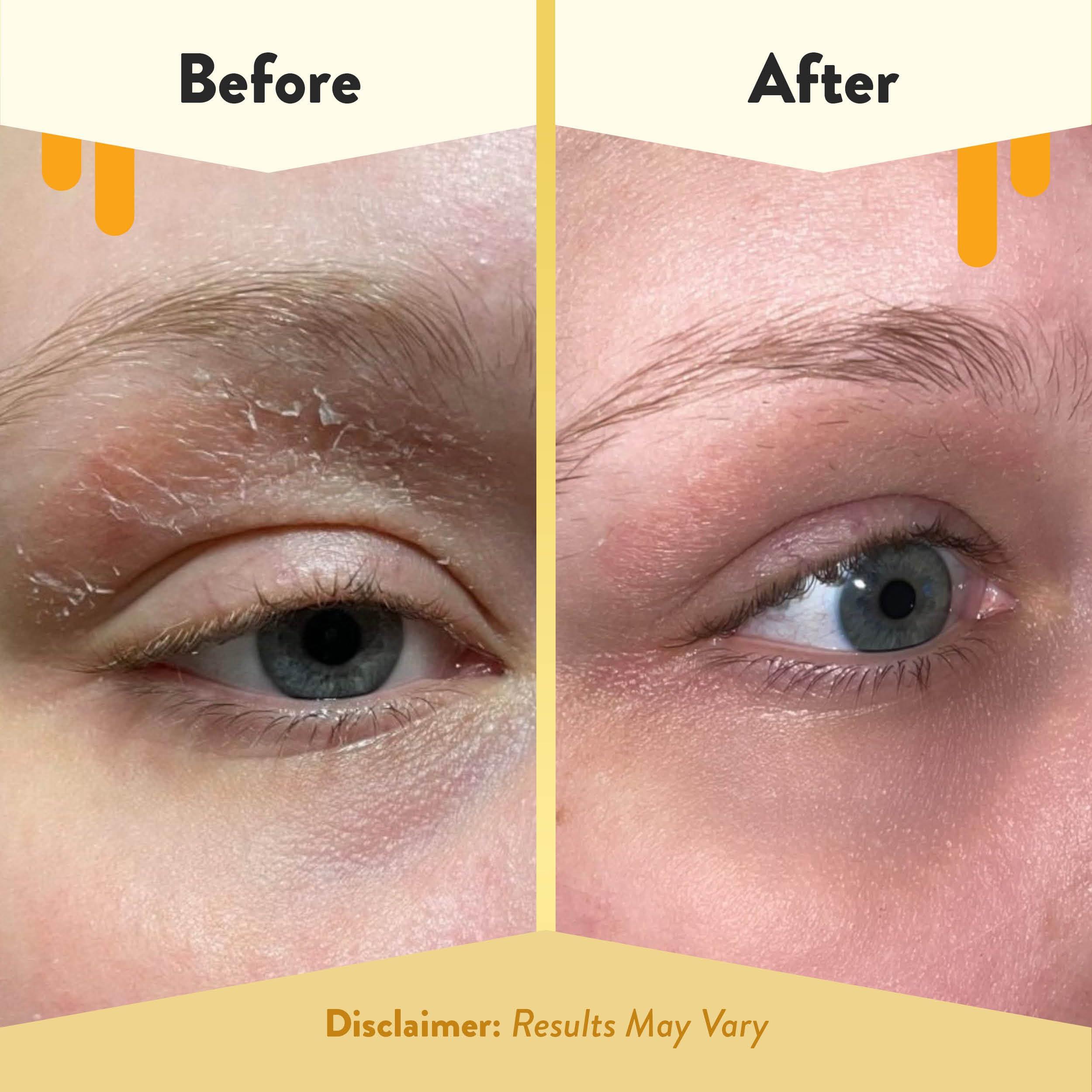 ECZEMA HONEY ECZEMA HONEY Multi Peptide Eye Cream & 15% Vitamin C + Ferulic Acid Serum - Bundle for Sensitive & Dry Skin - Cruelty Free