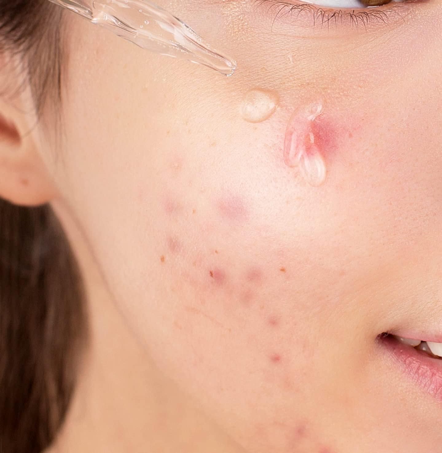 CARE:NEL Korean Skin Care Serum Vitamin B, C Serum for Face - Niacinamide 10% Zinc 1% - K Beauty Hydrating Facial Serum - 1fl.oz.(30ml)