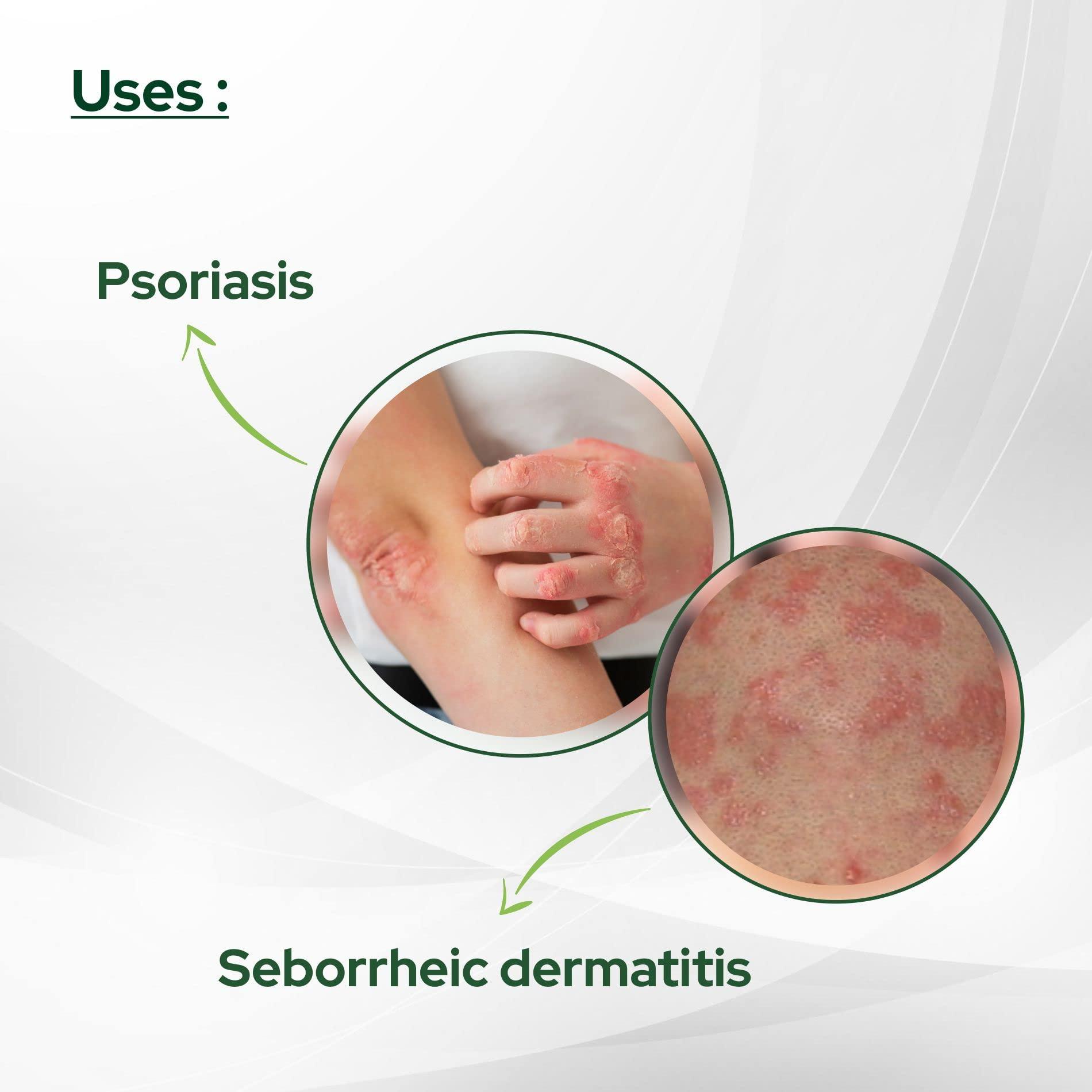 Salve COAL TAR SOAP 75GM, 2.64OZ | With Bergamot, Tea Tree, Jojoba, Chamomile and Aloe Vera Oil | Relieves Dry, Itchy skin Pack of 12