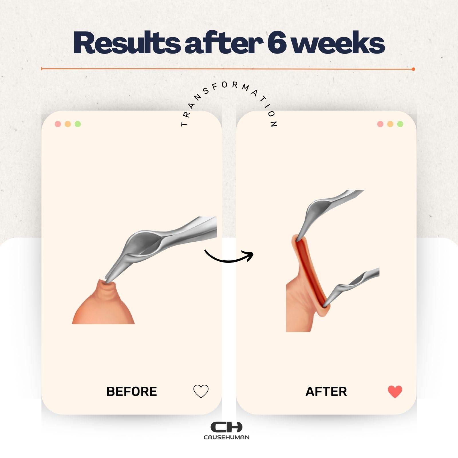 Cause Human GlanMax tool for phimosis | Phimosis Stretching tool | Opens upto 24mm | Safe & very quick results