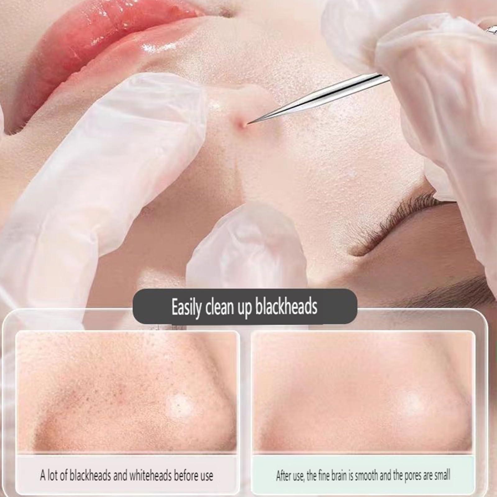 Dosurgorn Usiveinborn Blackhead Remover, Usiveinborn Tweezers, Professional Facial Blackhead Remover Tweezers, Stainless Steel Blackhead Tweezers Professional Tool Set, Blackhead/Pimple Extracto (7PCS)