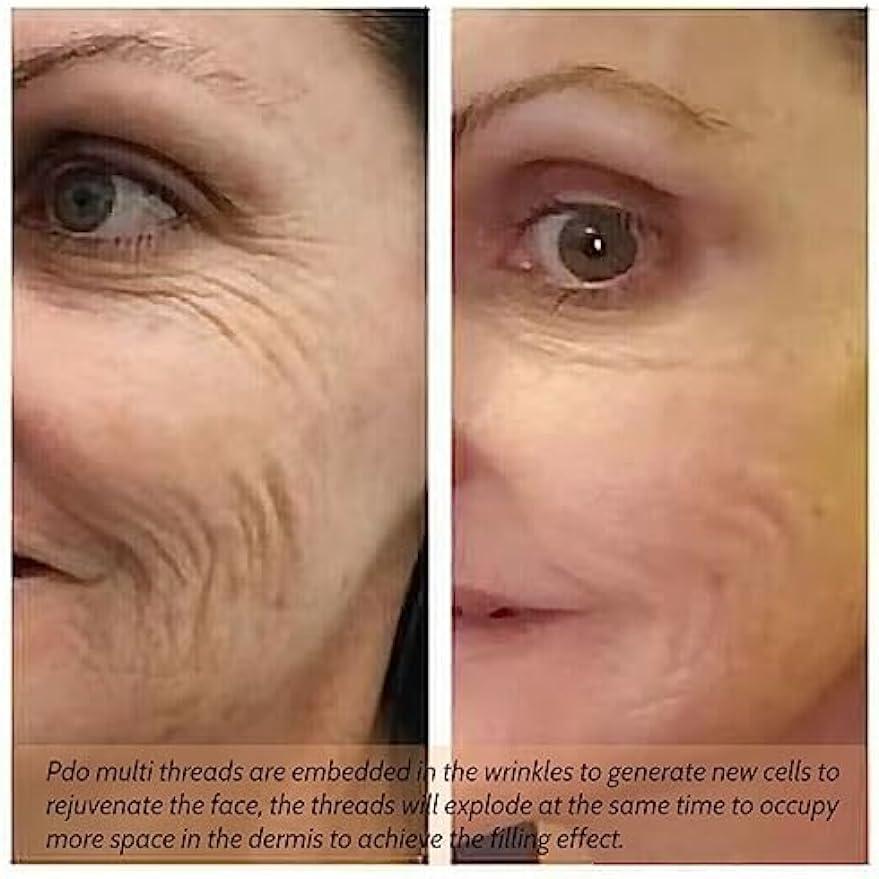 MatYas Pdo Pcl Multi Threads,23G38MM, for Face Lift,Removing Wrinkle Nasolabial L-Type,20pcs (PDO)