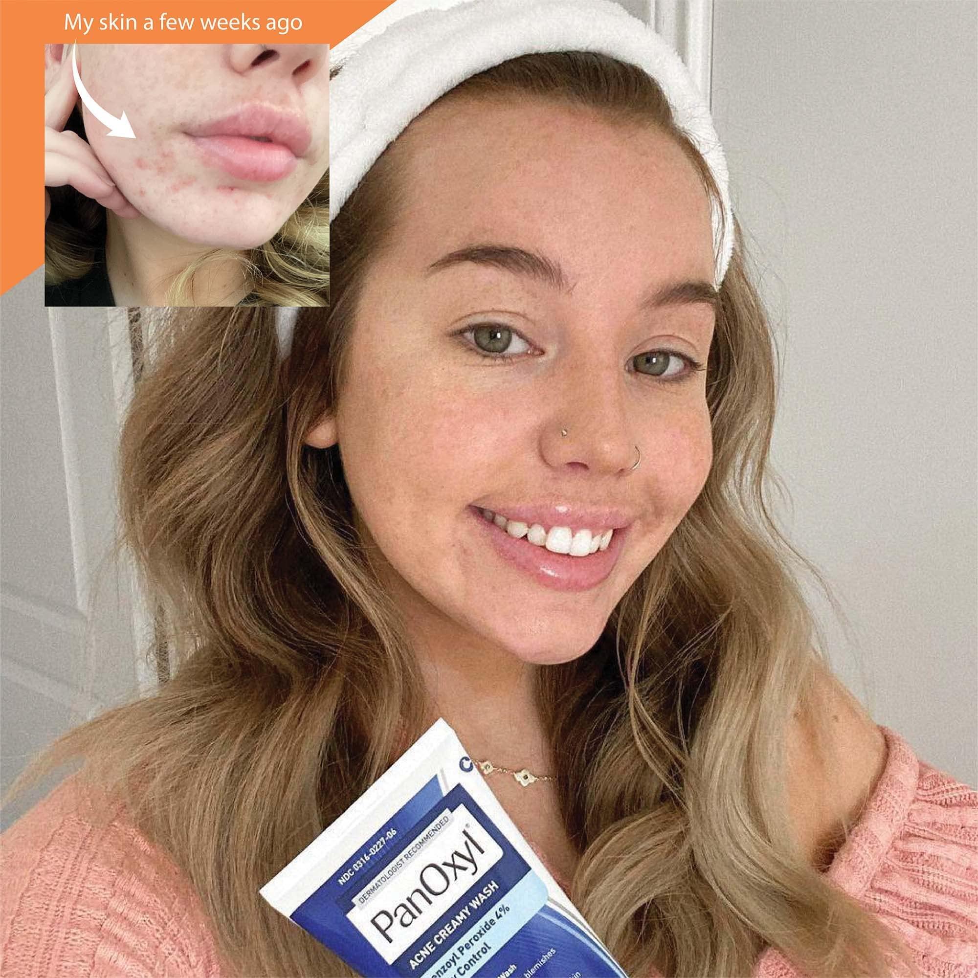 PanOxyl Panoxyl Acne Wash 4% Bundle with PM Patches, Cleanser