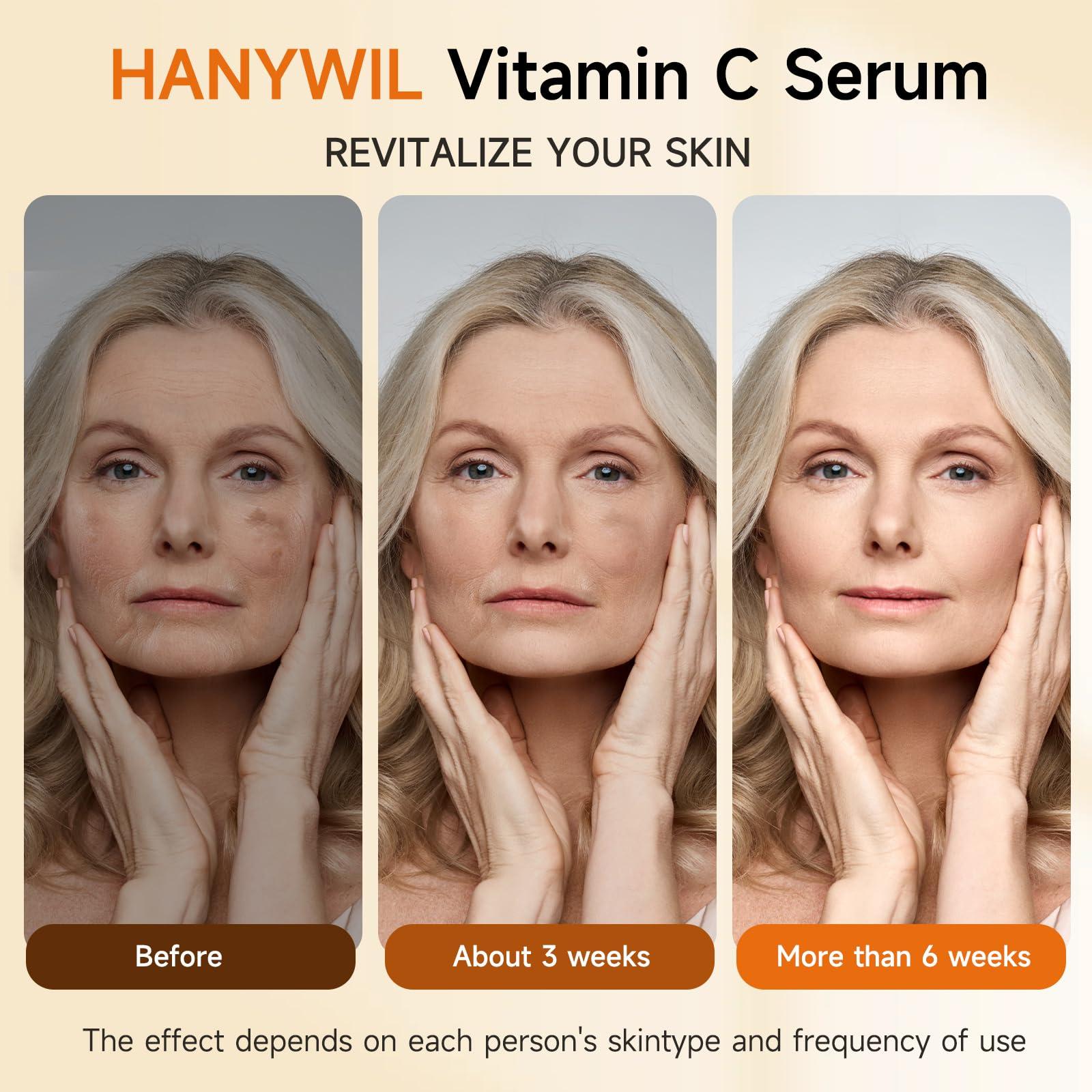 HANYWIL HANYWIL Super Vitamin C Serum for Women over 70, Vitamin C Serum for Face, Dark Spot Remover for Face, Hyaluronic Acid Skin Care, Targets Age Spots, Hydrates and Wrinkle Reduction 1.7fl oz