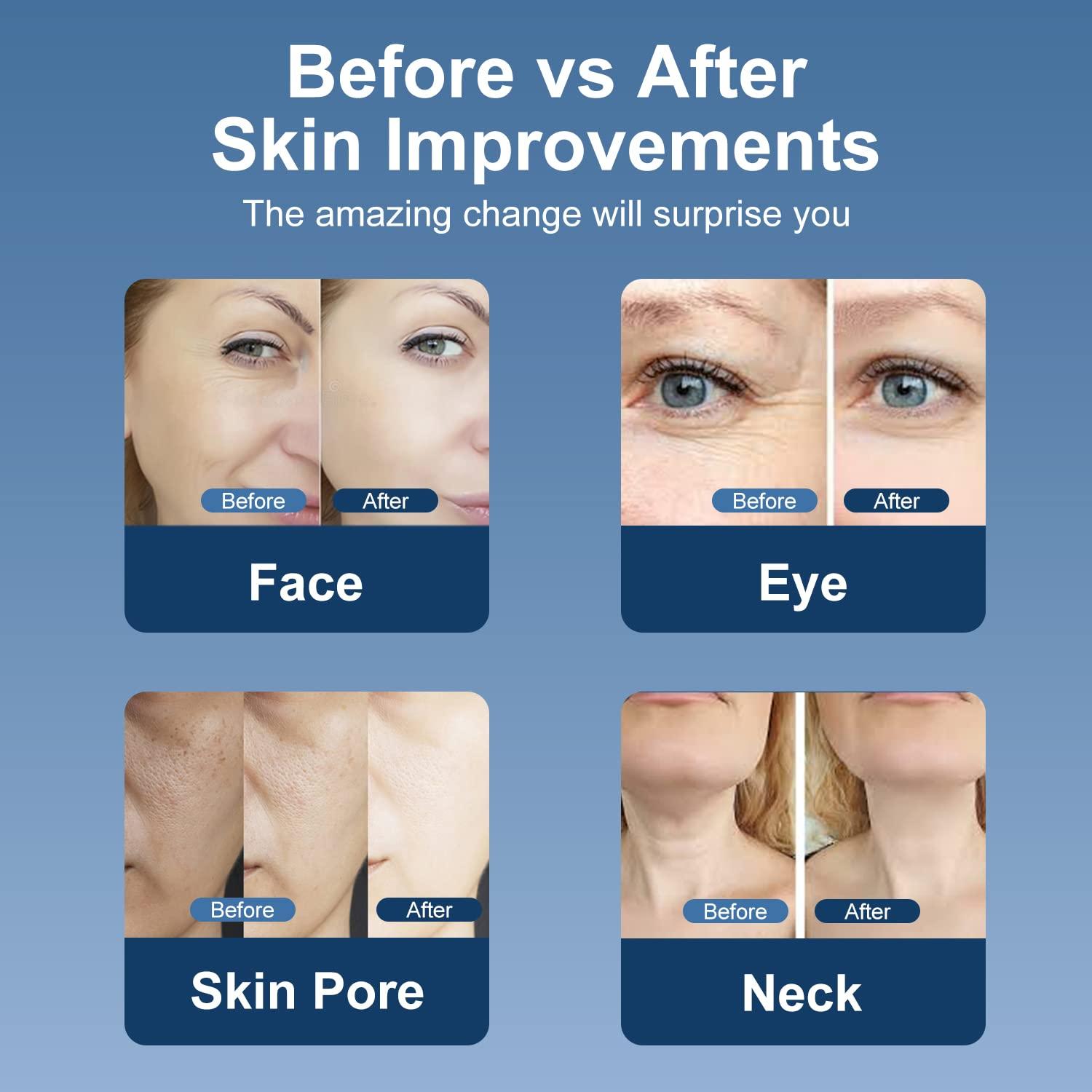 MiSMON MiSMON High Frequency Facial Machine, 5 in 1 Mutifunctional Facial Massager Skin Tightening Light Theraphy Machine for Face