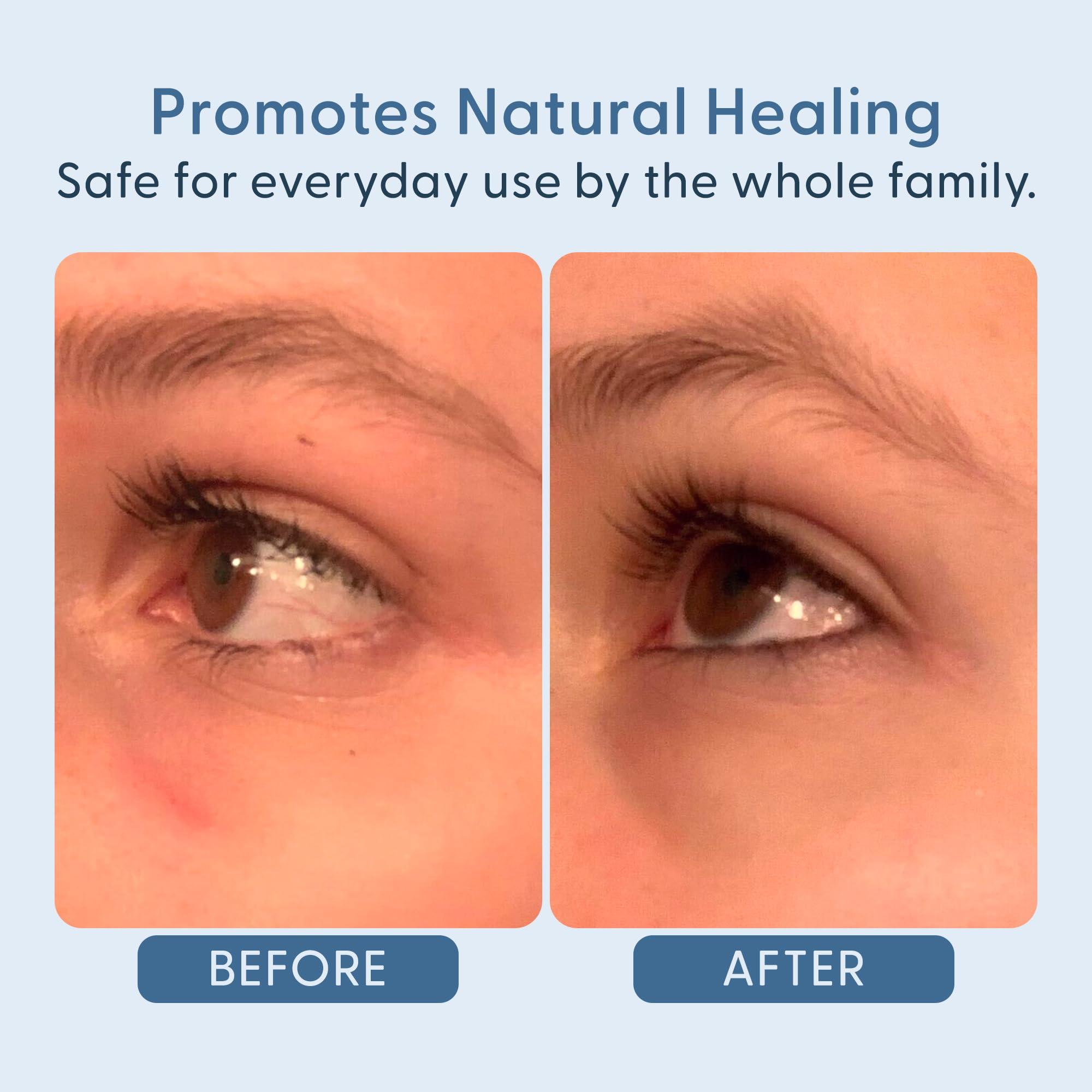 twenty/twenty beauty twenty/twenty Easy On The Eyes  0.02% Hypochlorous Acid Spray to Cleanse Eyelashes  Reduce Eyelid Irritation  Safe for Sensitive Skin  Ophthalmologist DevelopedVegan, Clean Ingredients  60ml