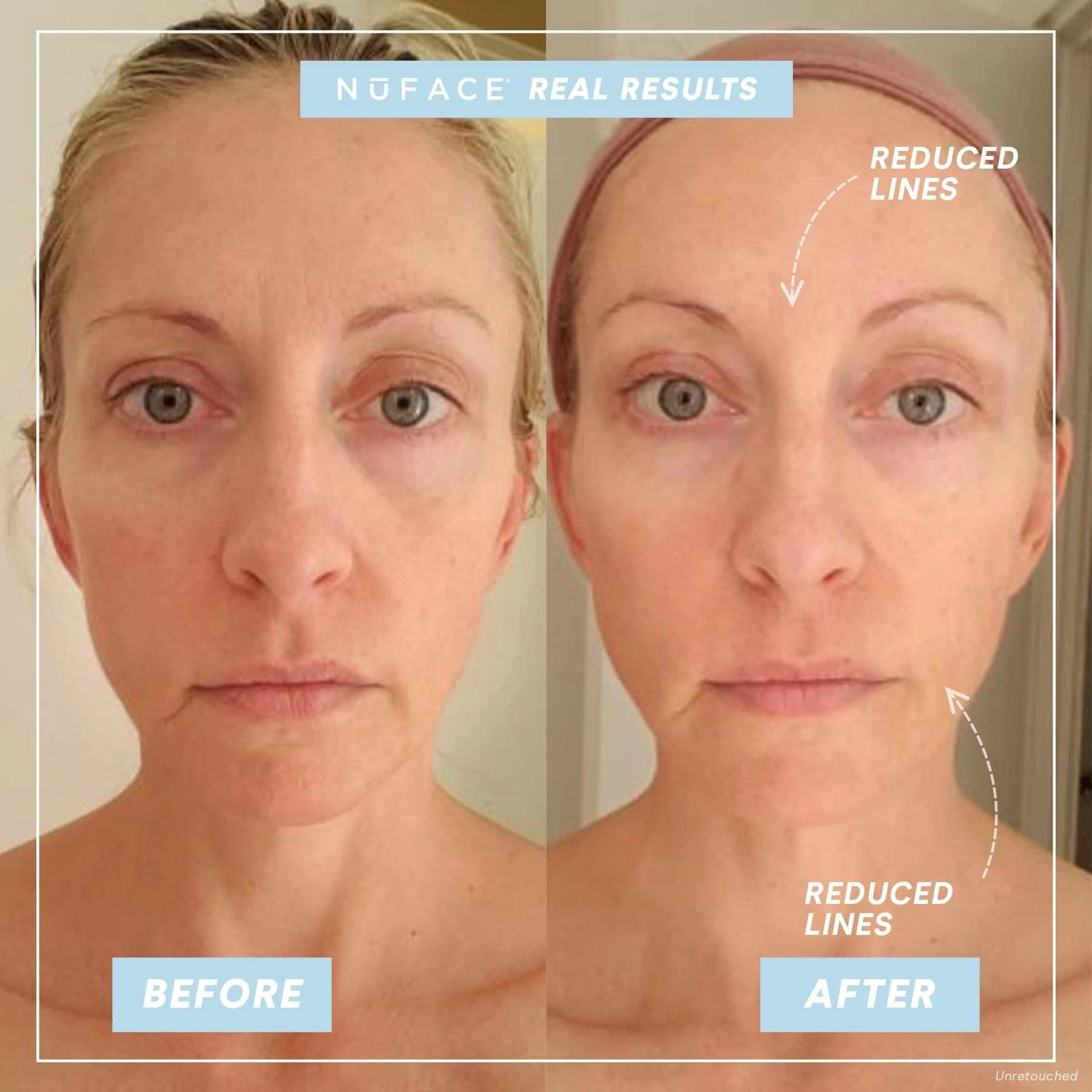 NuFACE NuFACE Trinity Microcurrent Facial Device Kit - FDA Cleared Face Sculpting & Neck Tightening Device to Contour Cheeks & Brows + Microcurrent Gel Activator, Silk Crme & Brush