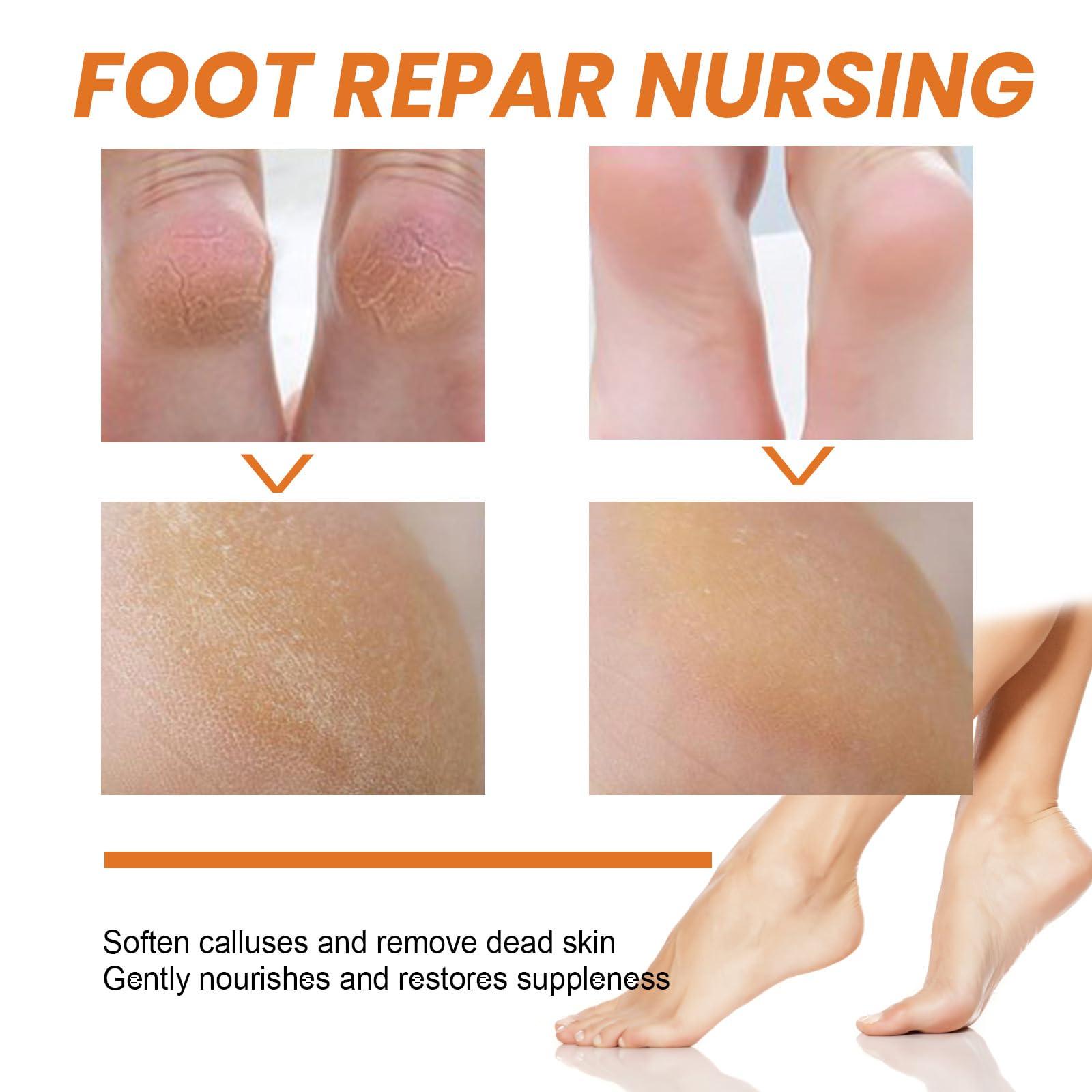 LOEBKE Foot Callus Removal Spray,Foot Heel Callus Remover Spray,Foot Peeling Spray Orange Oil,Foot Peel Spray That Remove Dead Skin,Exfoliating Peeling & Calluses On Feet (1PCS)