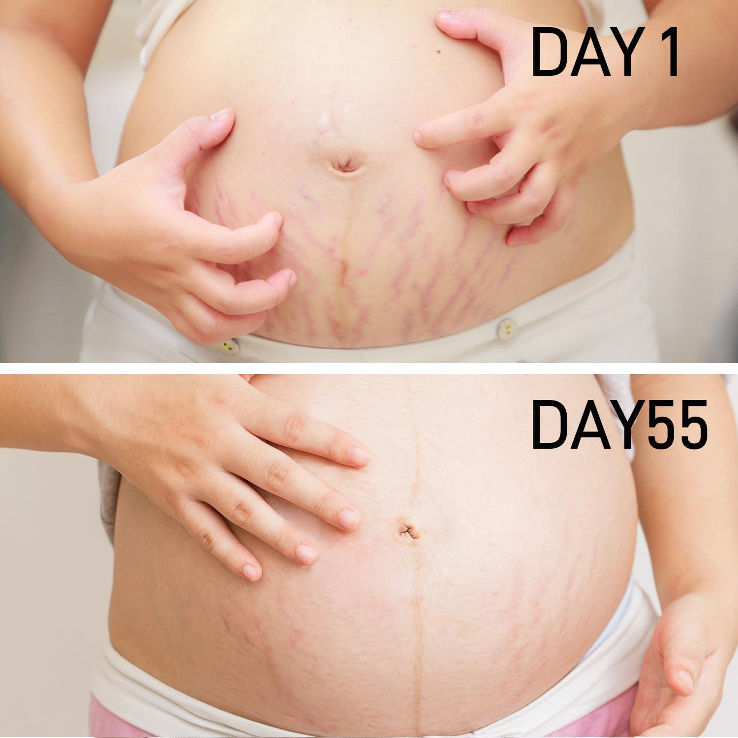 AOAO PEGO Stretch Marks Oil Maternity Body Oil for Stretch Marks Pregnancy Skin Care oil, Prevention & Reduction of Stretch Marks Pregnancy, 4.06 oz (2pcs)