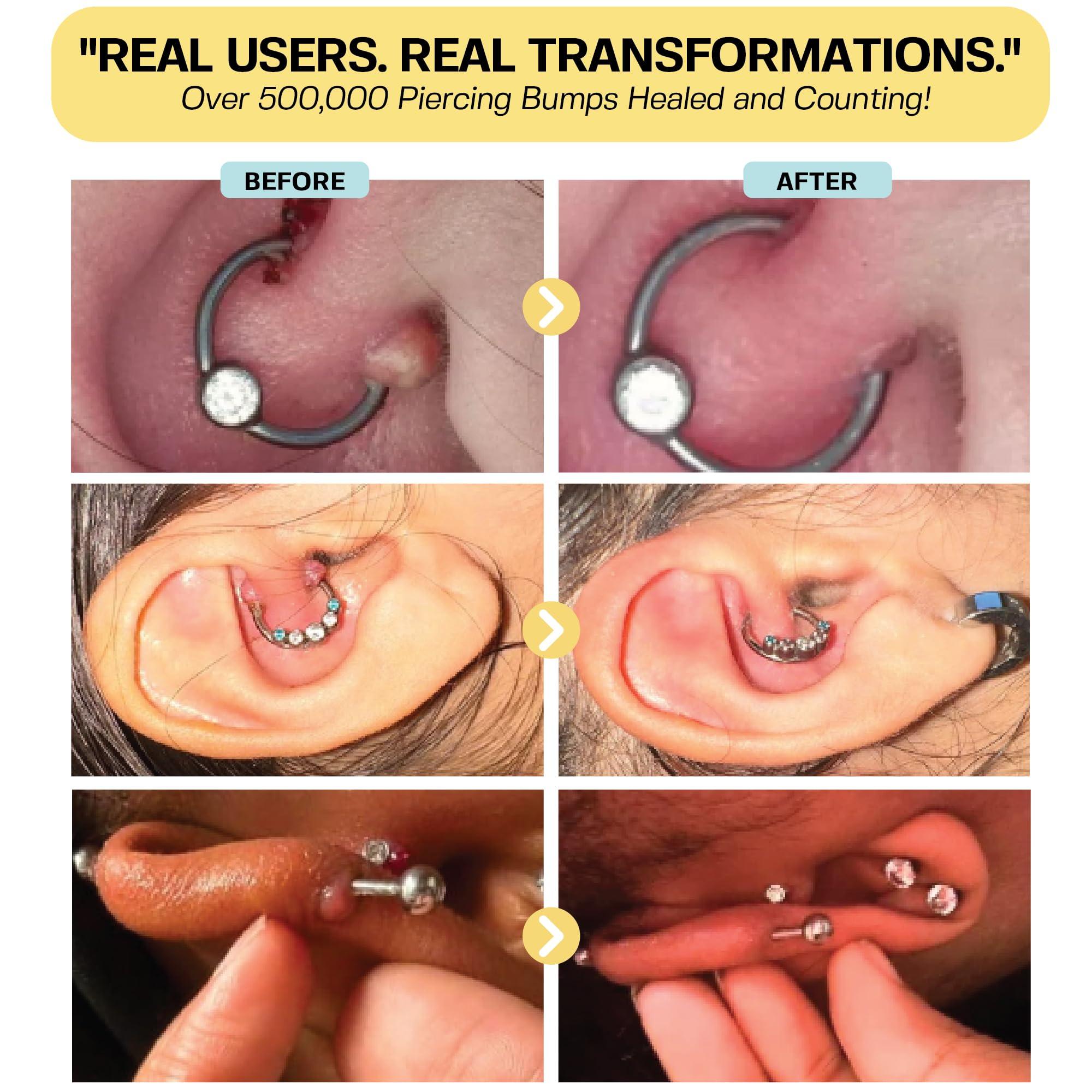 BASE LABORATORIES BASE LABORATORIES Keloid Bump Removal Gel | Natural Piercing Bump Treatment & Keloid Scar Gel | Keloid Scar Removal for all Scars, Keloids & Piercing Bumps | Soothing Piercing Aftercare Gel | 2 oz