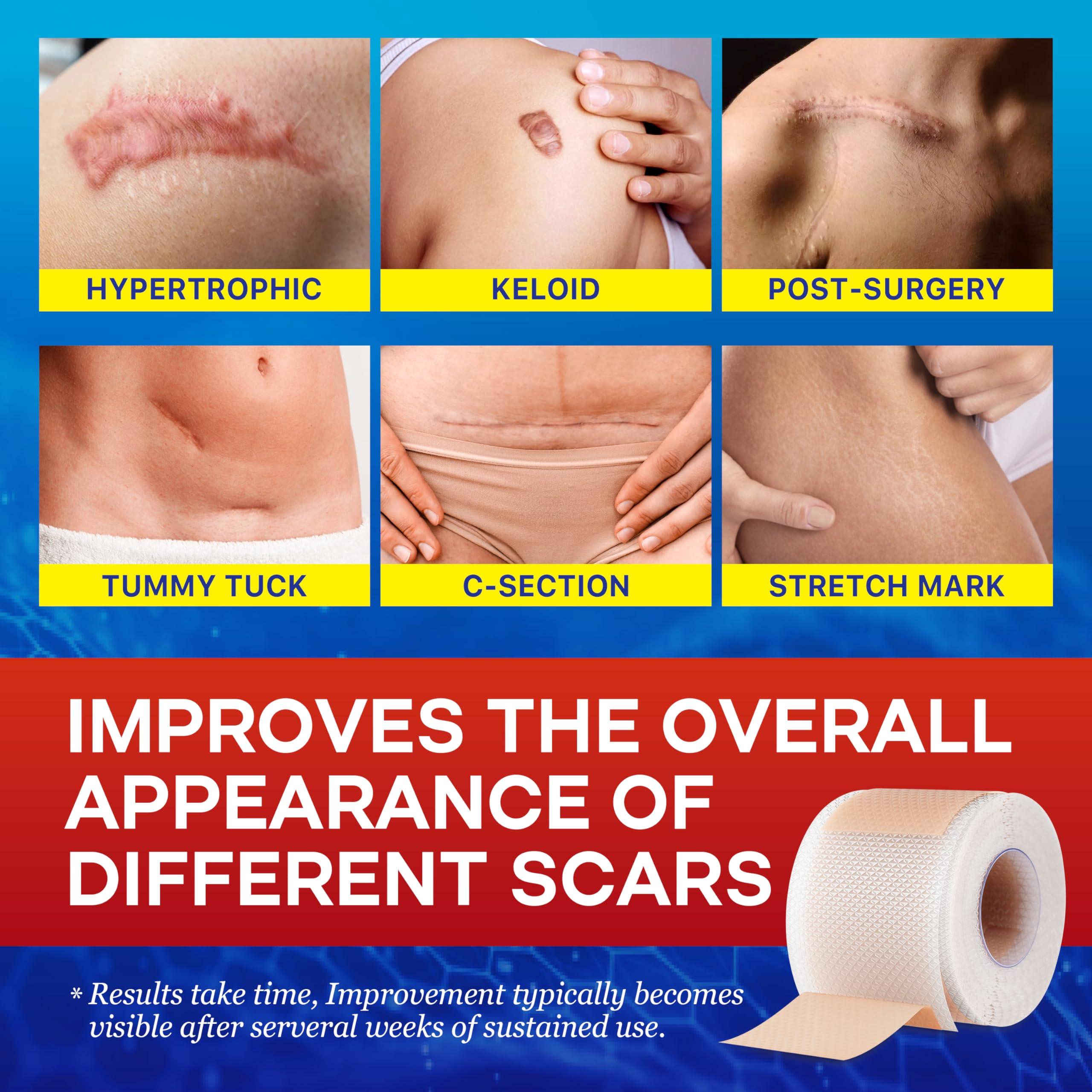 Umaeost 1.6\"x 120\" Medical Silicone Scar tape for Scars: Medical Grade Scar Sheets Reduces the Appearance of Scars from surgical Acne Stitches Burns More