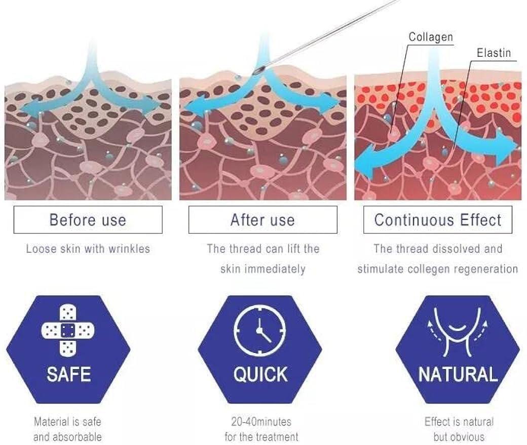 MatYas Pdo Cog 6D Threads 19G100MM, W-Type, 360R Bidirection Cog for Face Lift, 20pcs