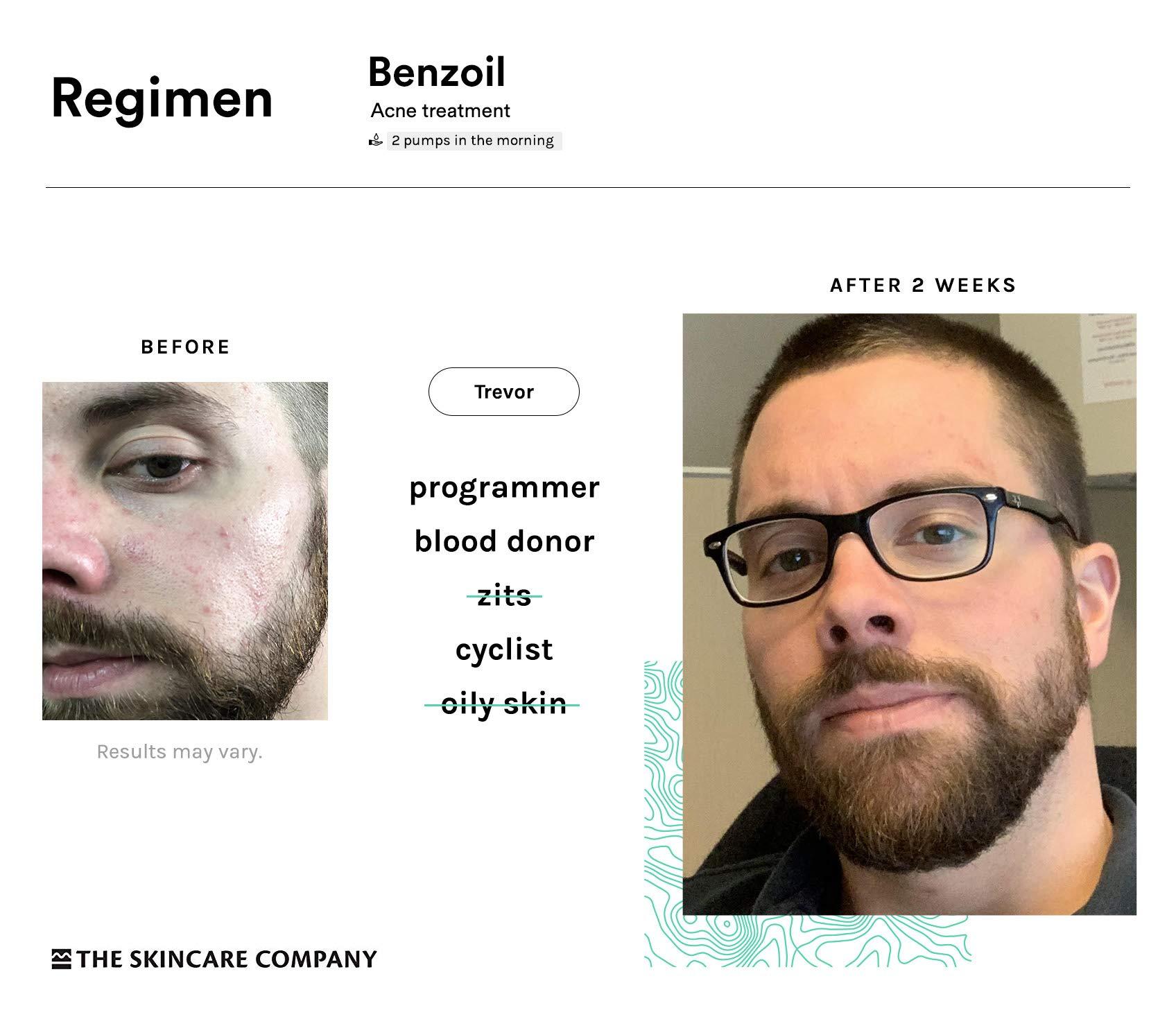 THE SKINCARE COMPANY Benzoil - 3% Benzoyl Peroxide & 2% Tea Tree Oil Rapid Acne & Spot Treatment Serum - 70% Organic, Preservative-Free, Normal & Cystic Acne - 2 oz