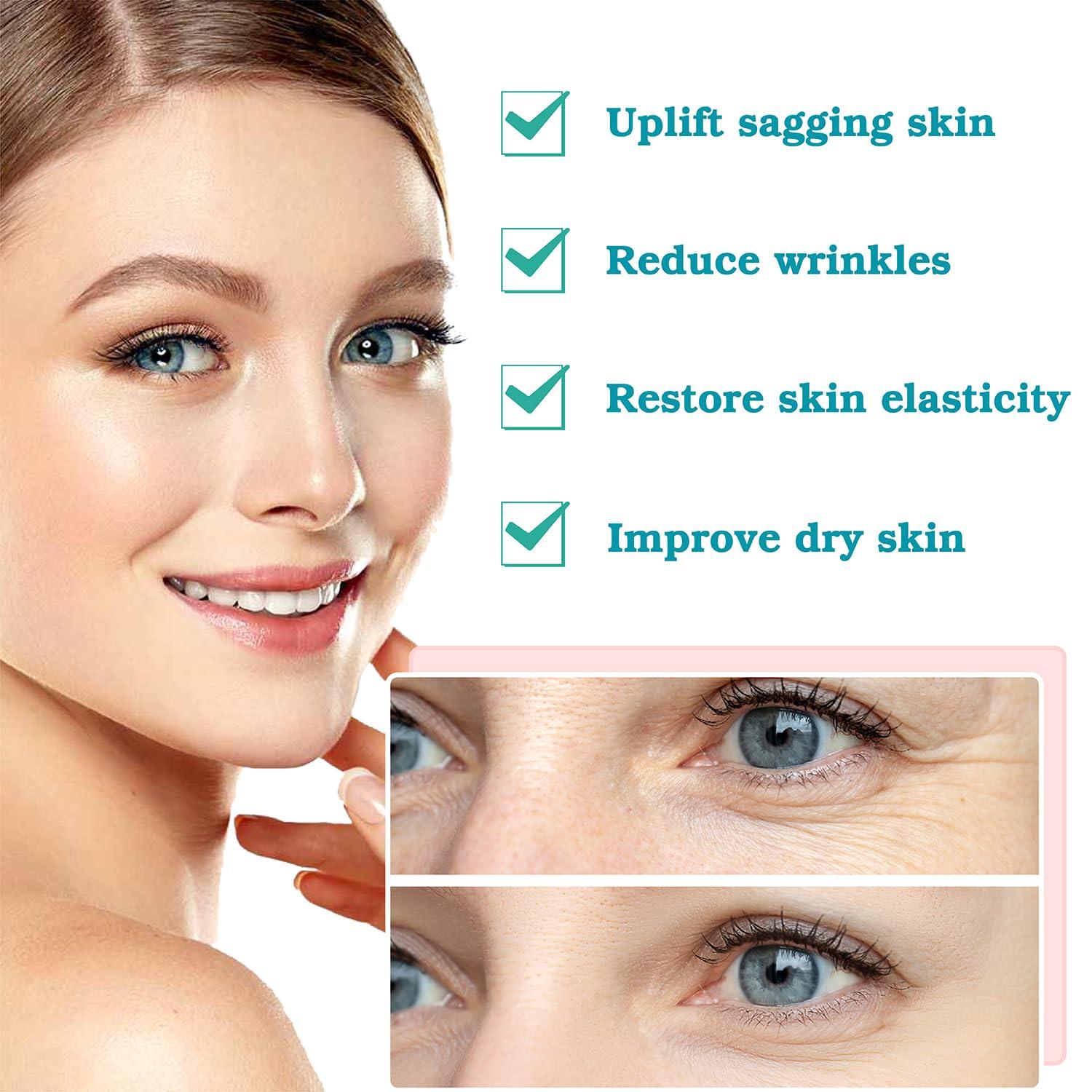 Newliky Pdo Threads for Face Lift Mono Screw Type (29G50MM) Smoothing Wrinkles PDO Thread Lift for Whole Body with Sharp Tip 20pcs