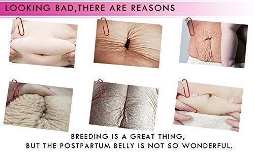 MQUPIN RtopR Mango Stretch Marks and Scar Cream -Stretch Marks and Scar Removal Cream for Pregnancy - Best Body Moisturizer-40g