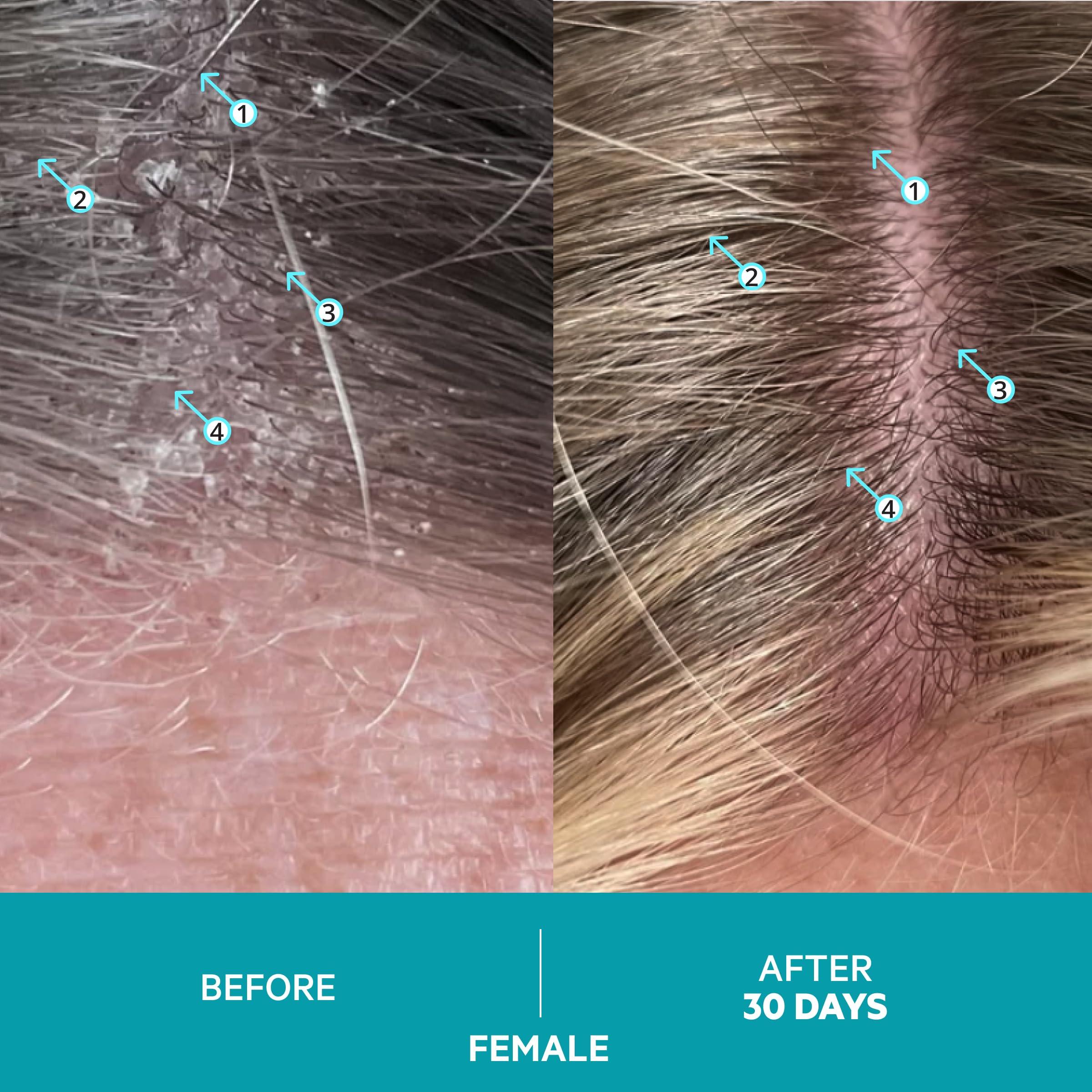 DS LABORATORIES DS Laboratories Dandrene Anti Dandruff Shampoo - Exfoliating Shampoo for Dry Itchy Scalp, Dandruff Scalp Treatment, Seborrheic Dermatitis & Psoriasis