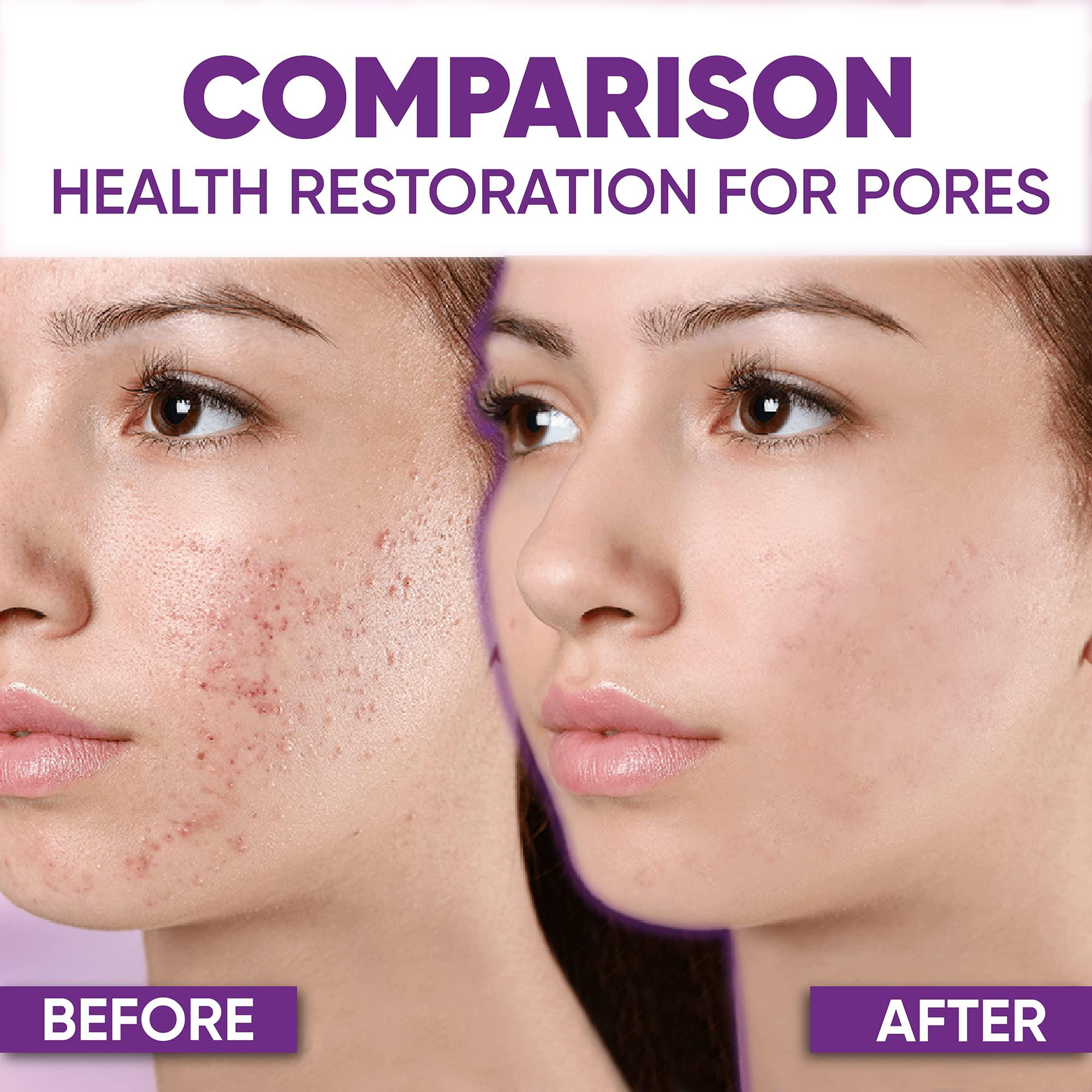 AOBBIY 10% Azelaic Acid Cream: Acne Treatment - Acne Cream - Redness Relief for Face - Redness Reducing Skin Care , Fix Discoloration, Prevent Breakouts, Enhance Skin Tone 1 OZ (2 PACK)