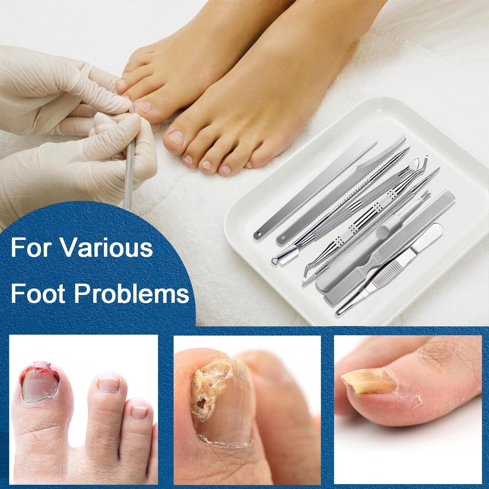 TOESCARE 11pcs Ingrown Toenail Tool Kit - Professional Ingrown Toenail Removal Kit for Podiatry Kit and Pedicure - Toenail Ingrown Correction Complete with Ingrown Toenail File Lifter, Sidewall Cleaner