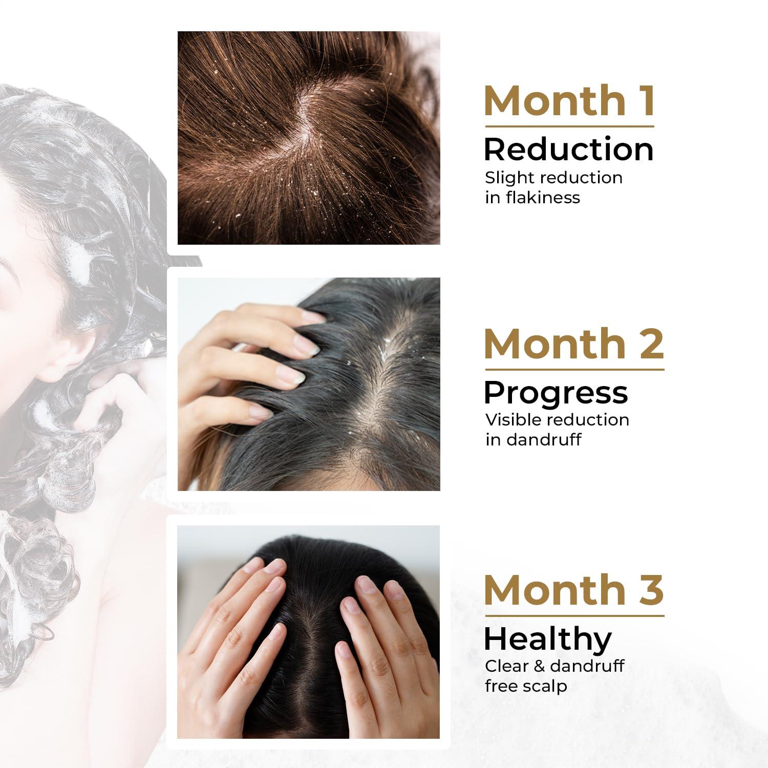 The Organic Forest  VEGAN . PURE . NATURAL Organic Anti Dandruff Shampoo and Conditioner Set | Infused with Apple Cider Vinegar, Tea Tree Oil & Shea Butter | Sulfate-Free, Hydrating, Frizz Control | Curly Hair, Men & Women, Natural Ingredients