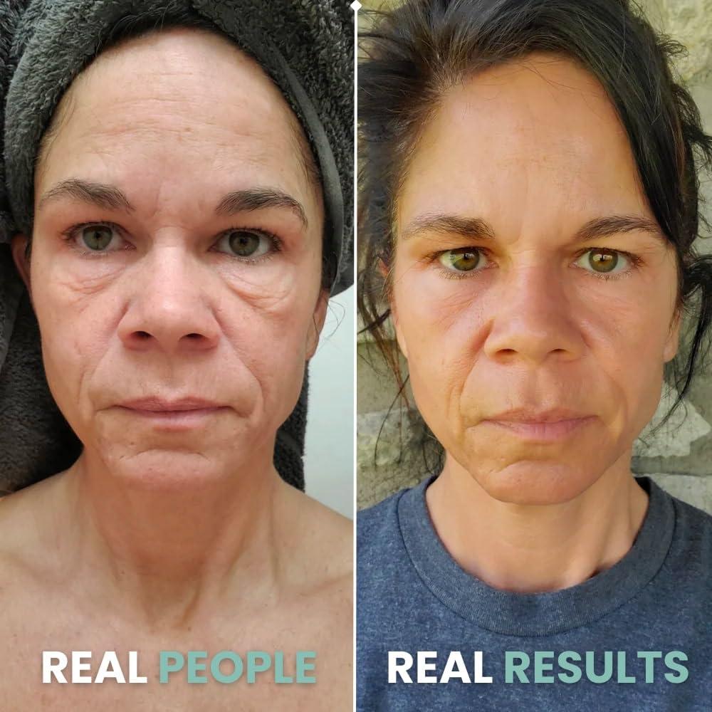 Gin Amber Gin Amber Dermaroller (0.25mm) - 192 Real Individual Needles, Microdermabrasion Device for Skin Care, Serum Absorption with Microneedling, Safe and Painless Revitalizer Tool, Hygienic Case