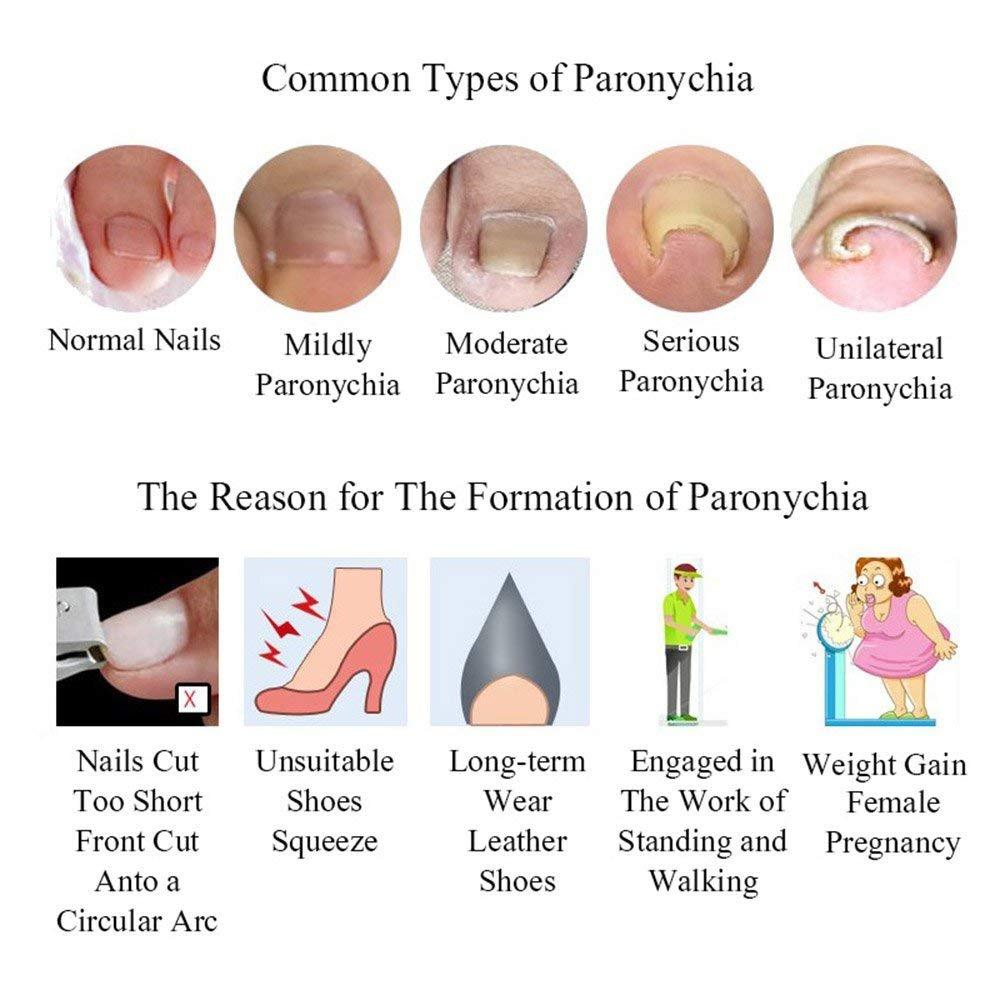 Gnker Ingrown Toenail Pedicure Tool Straightening Clip Curved BS Brace for Toenails Toe nail (Tool Kit)