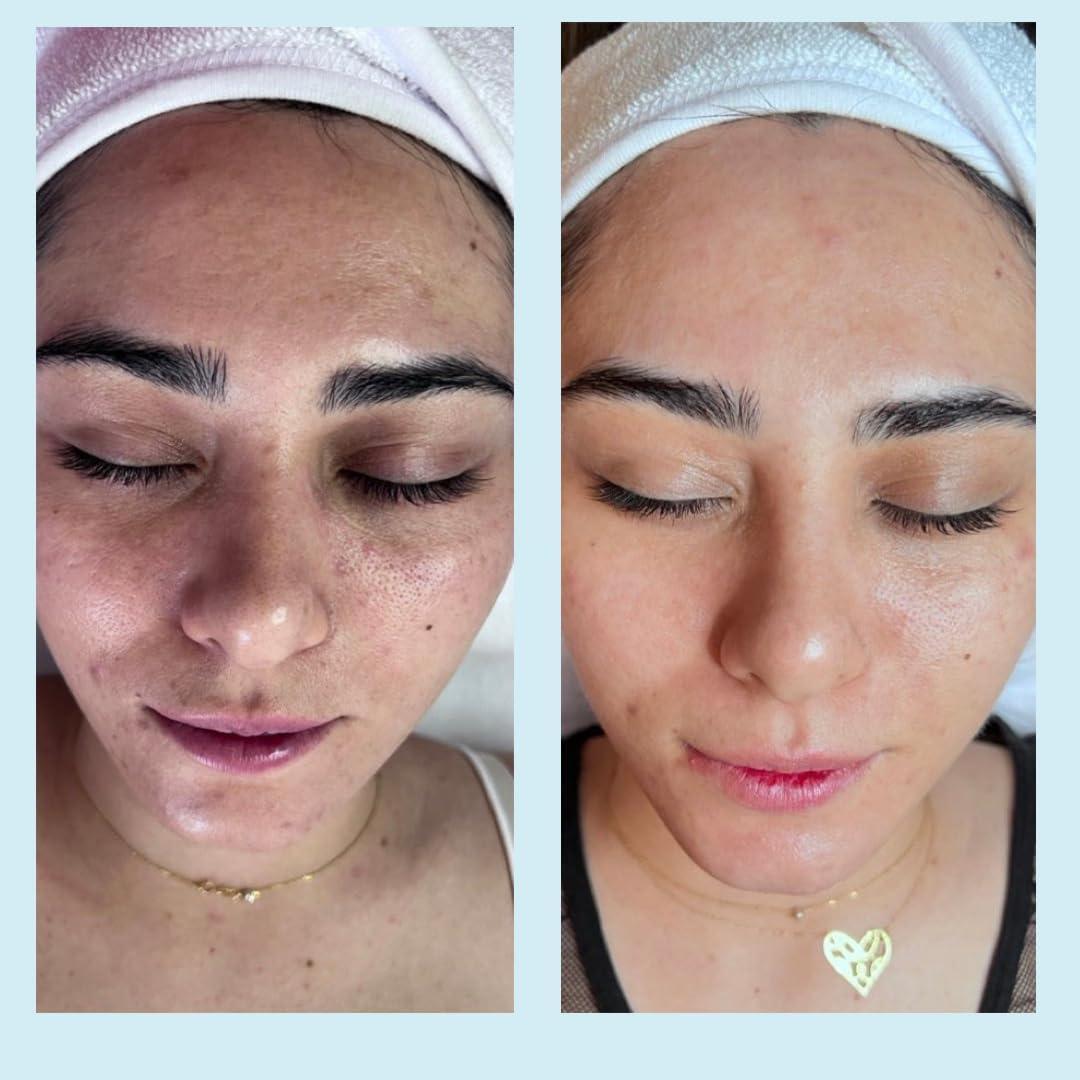 Perfect Image Salicylic Gel Chemical Peel - Enhanced with Green Tea Extract and Tea Tree Oil (20% Strength)